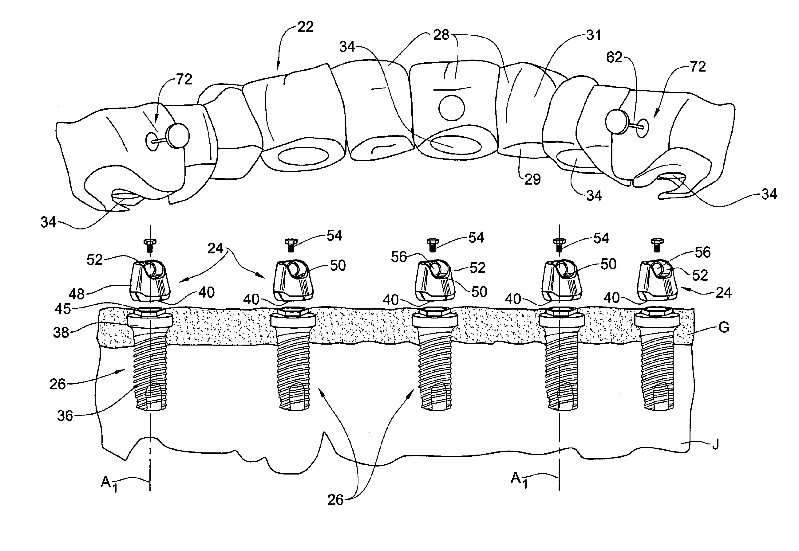 Dental bridge system and method