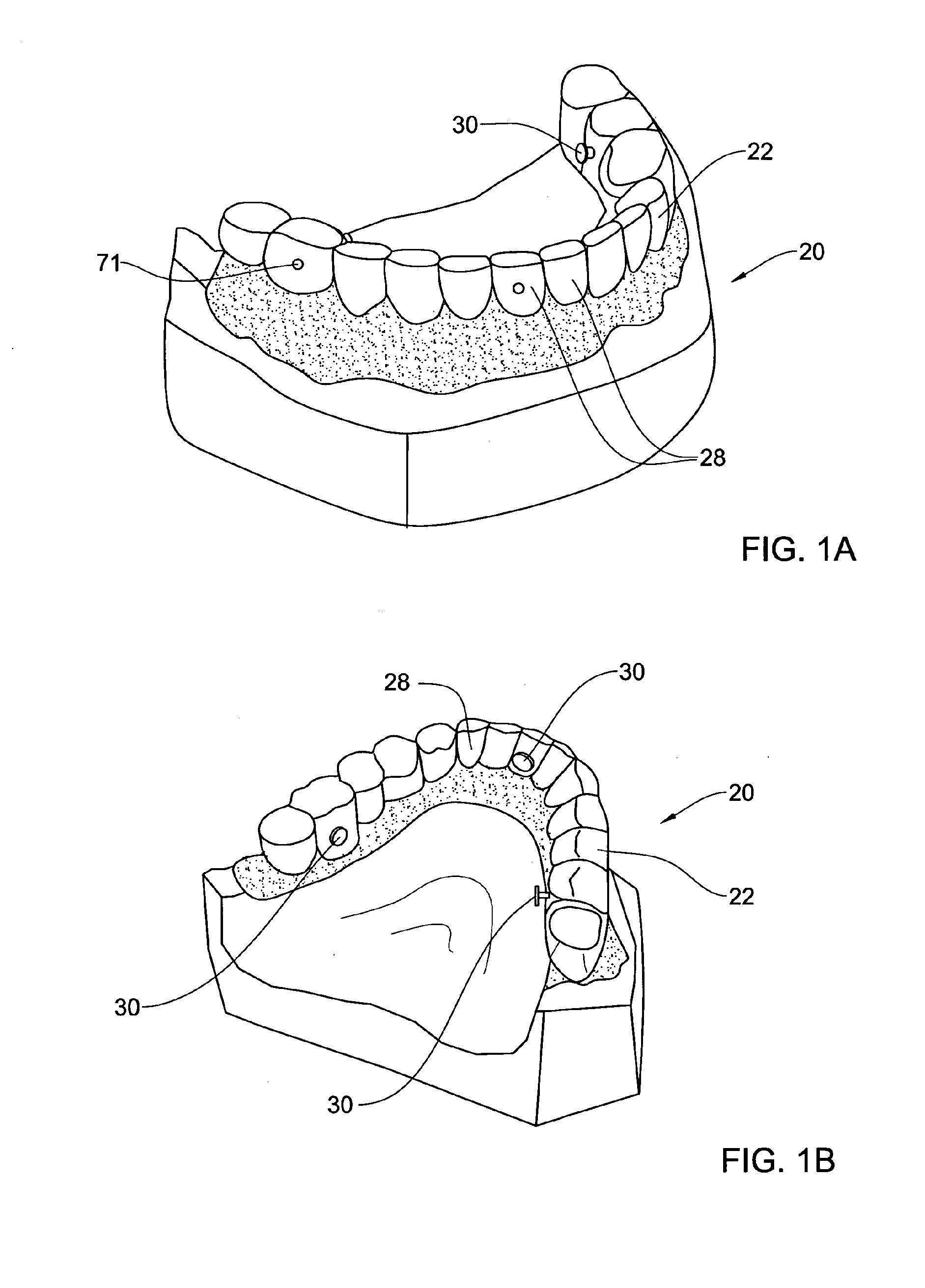 Dental bridge system and method