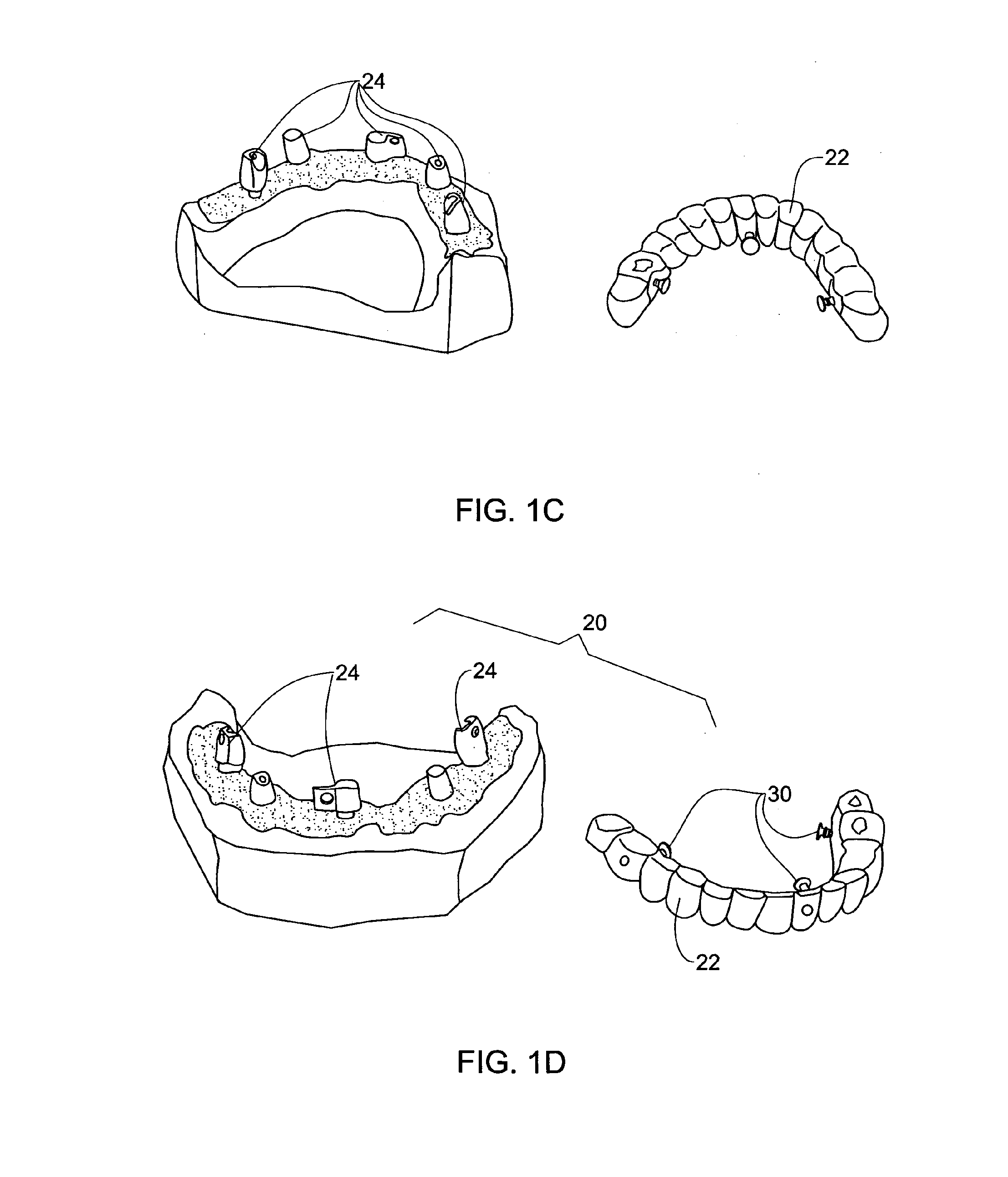 Dental bridge system and method