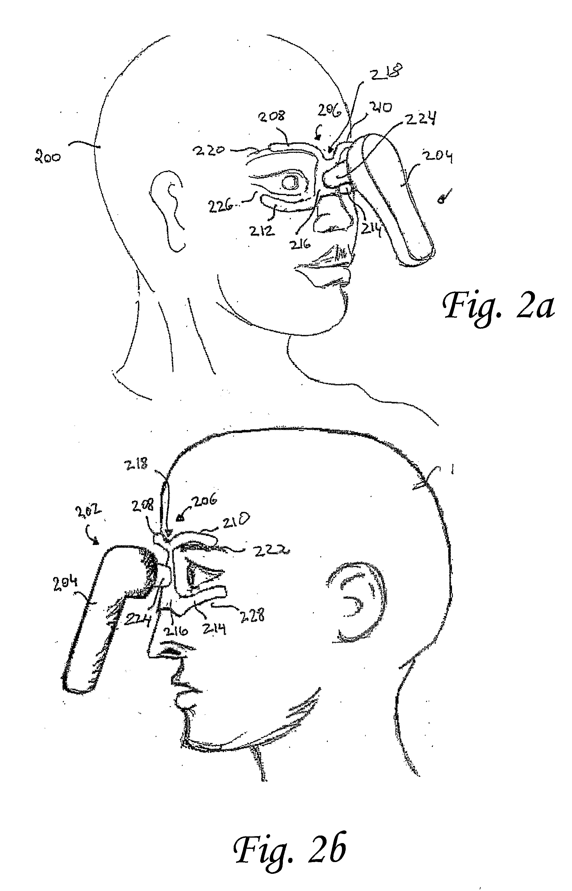 Vibrating Device For Treating Nasal Congestion and Sinusitis Symptoms and Method Thereof