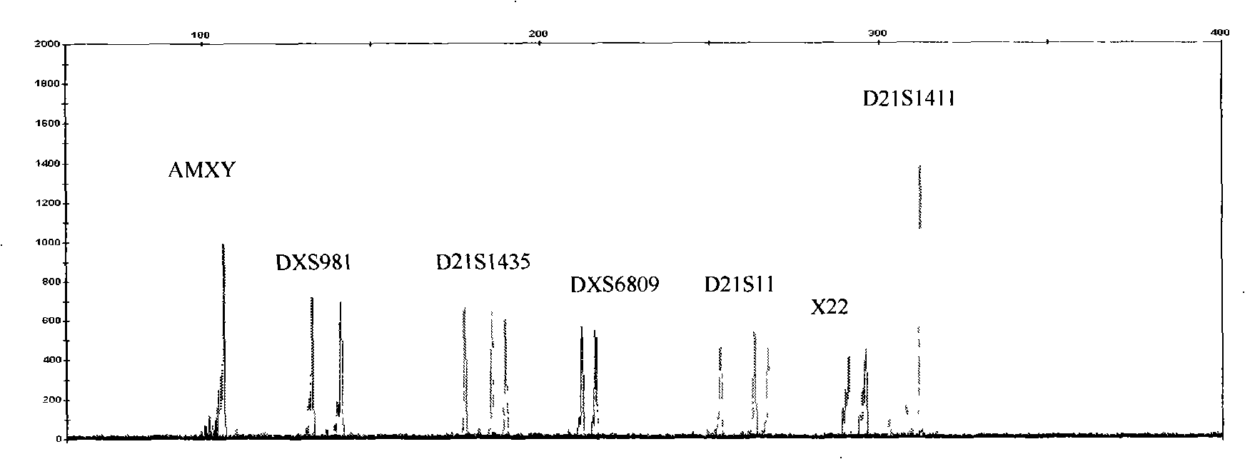 Reagent box for detecting No 21 chromosome and idiochromosome number abnormality