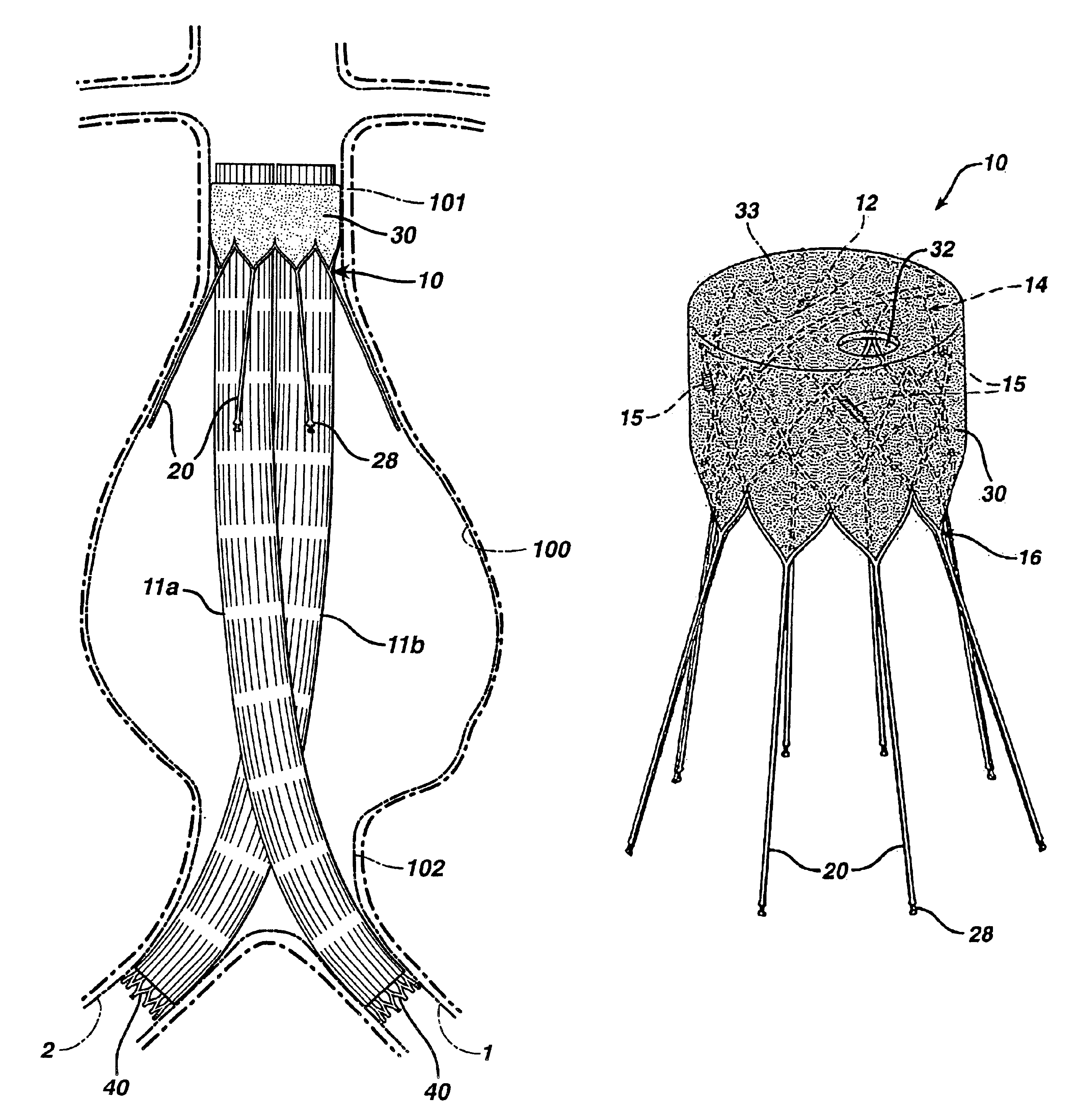 Extension prosthesis for an arterial repair