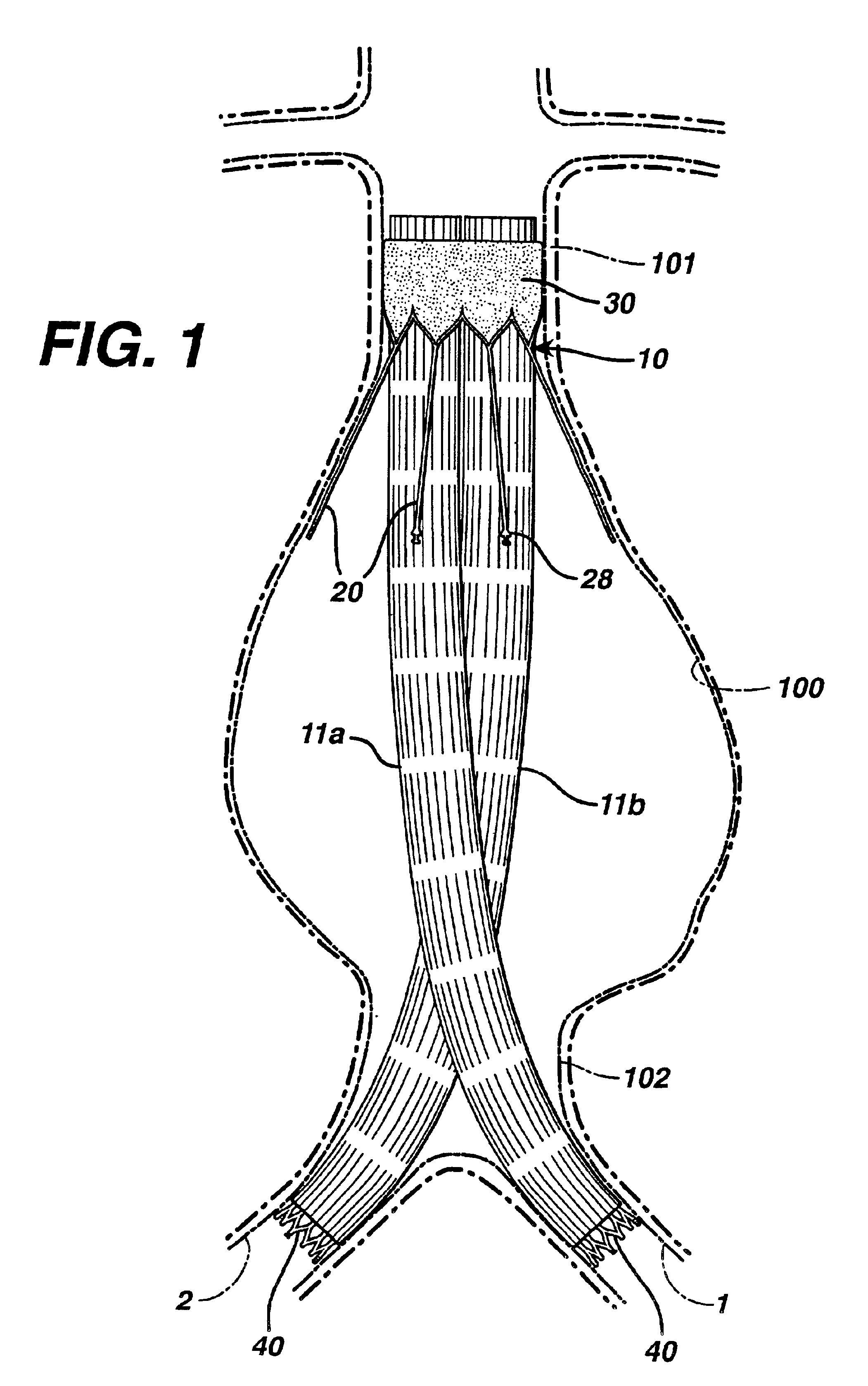 Extension prosthesis for an arterial repair