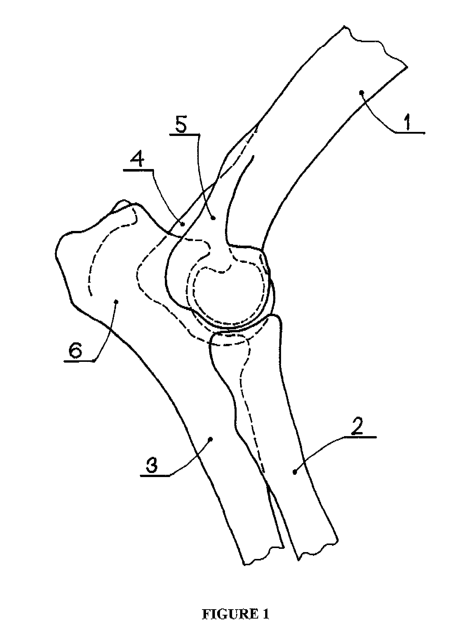 Elbow joint prosthesis and method for implantation