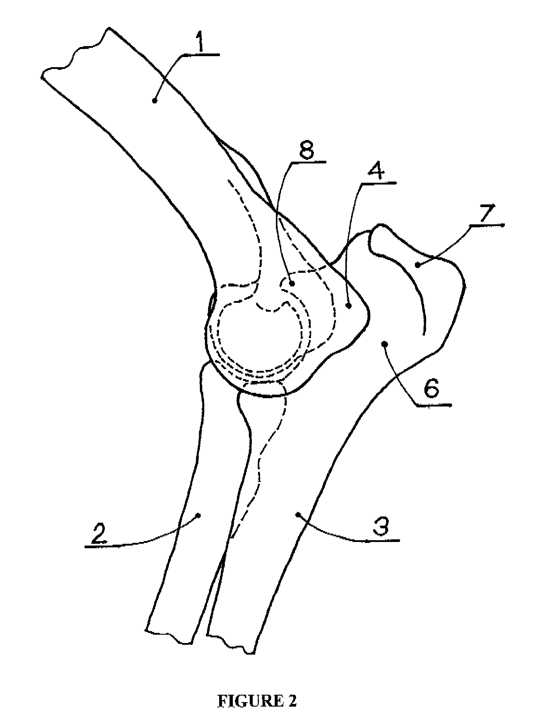 Elbow joint prosthesis and method for implantation