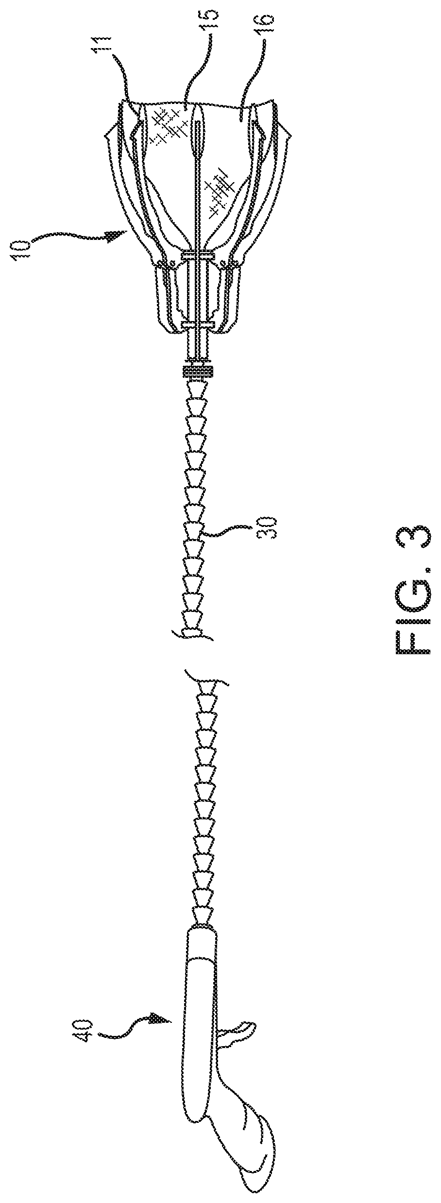 Medical device to remove an obstruction from a body lumen, vessel or organ