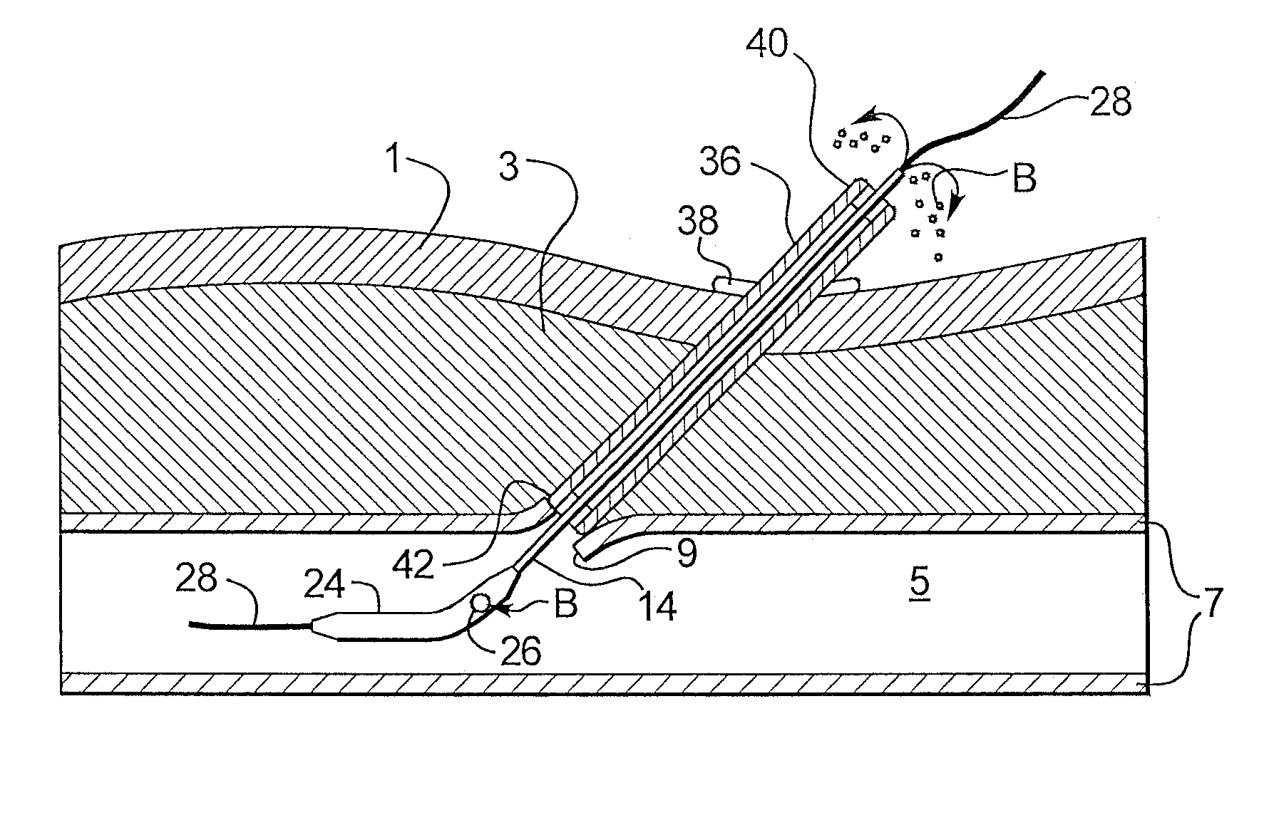 Depth and puncture control for system for hemostasis of blood vessel