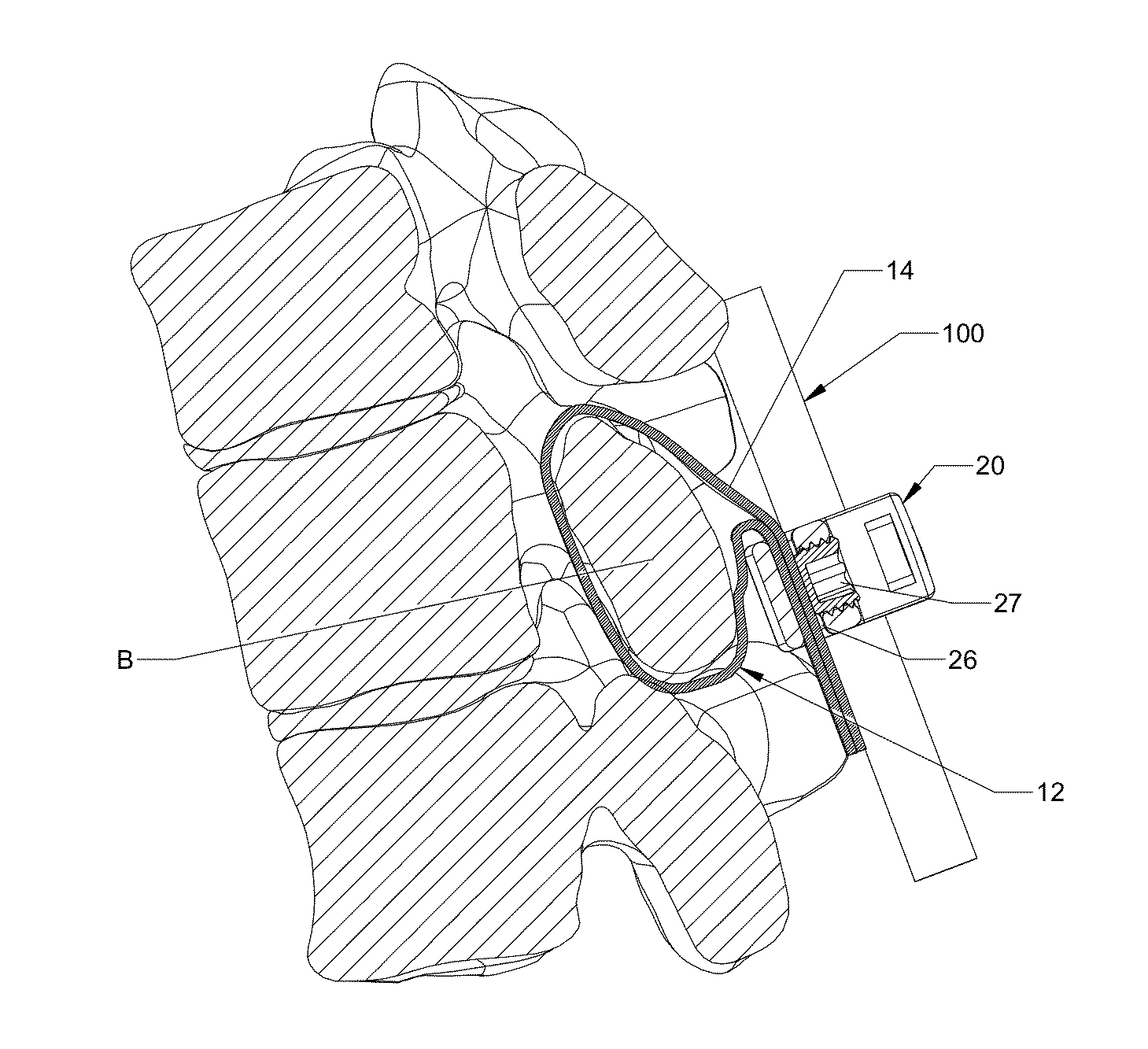 Flexible fastening system