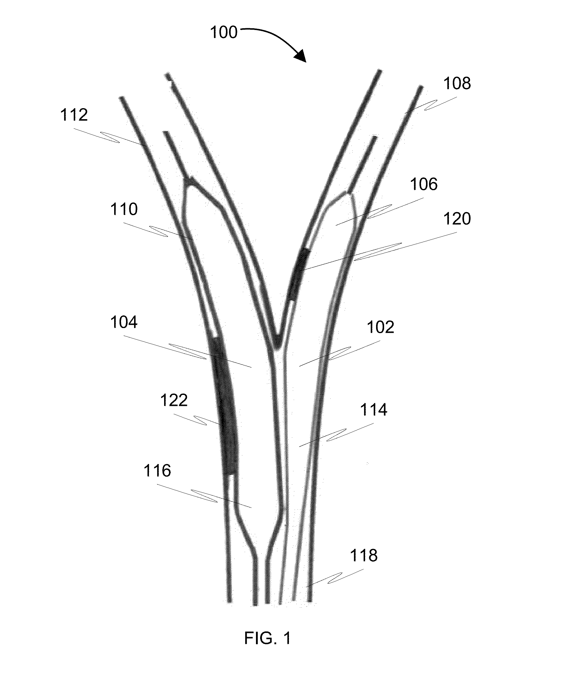 Method and a balloon catheter assembly for treating bifurcation lesions