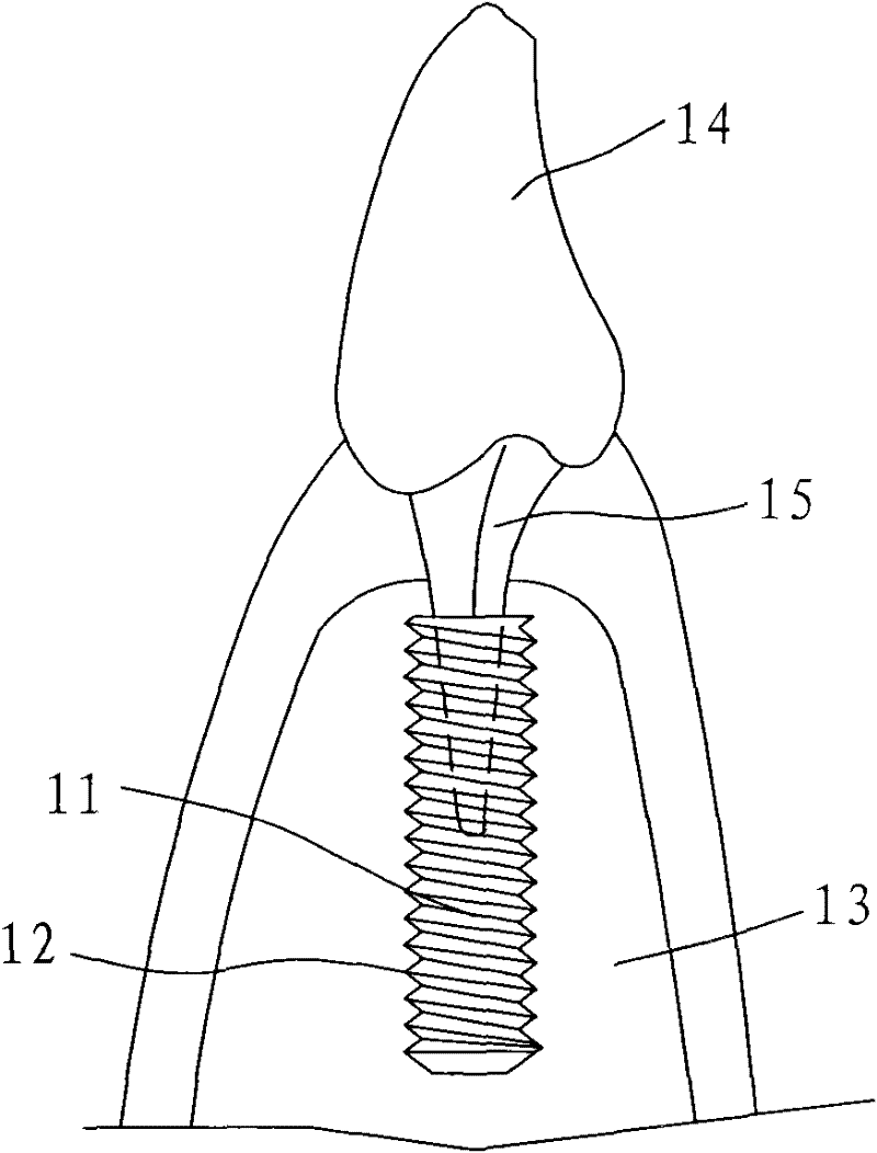 Artificial tooth root with nanostructure