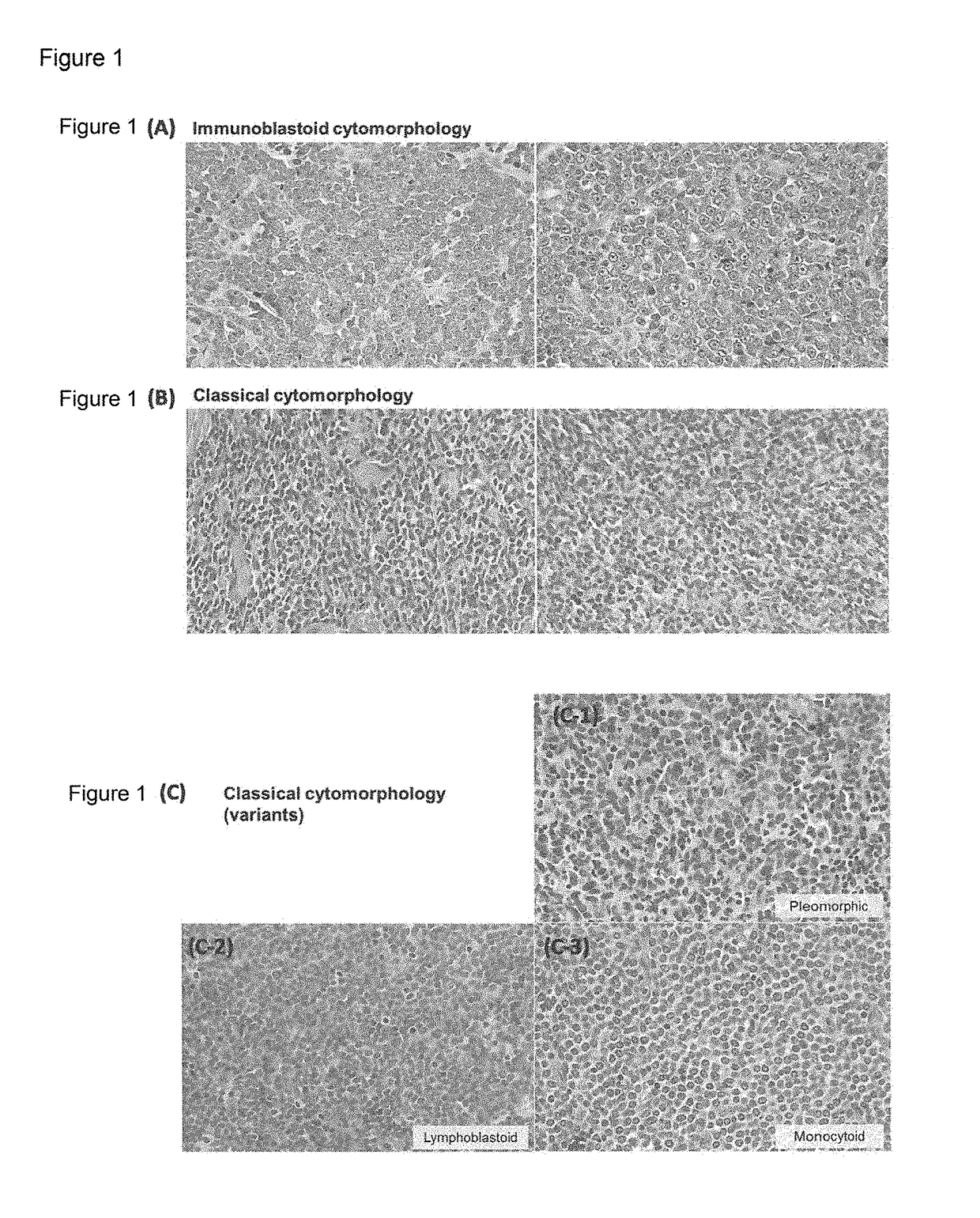 Diagnosis marker for rare hematopoietic tumor, test method, therapeutic agent, and screening method