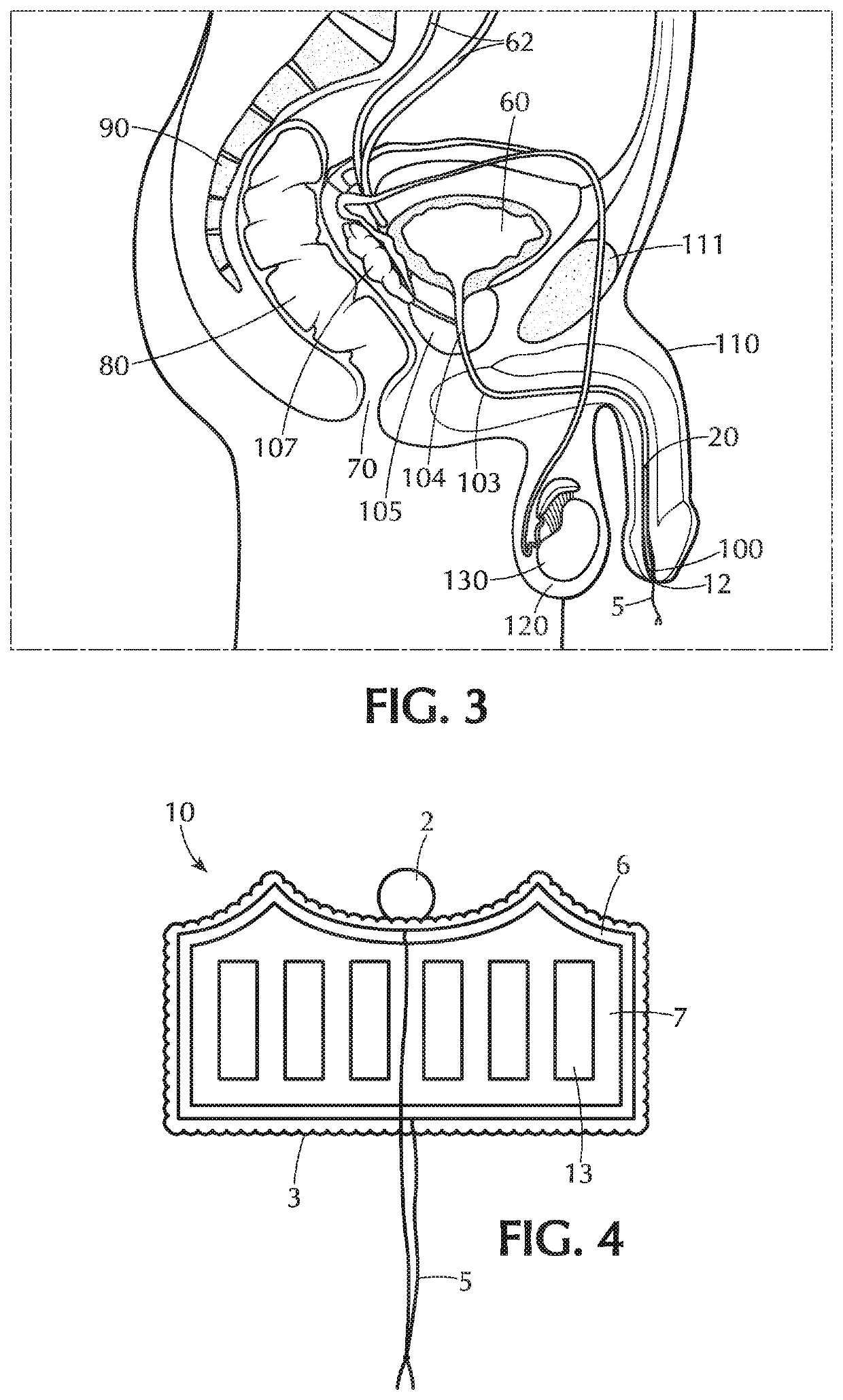 Urinary Plug Device