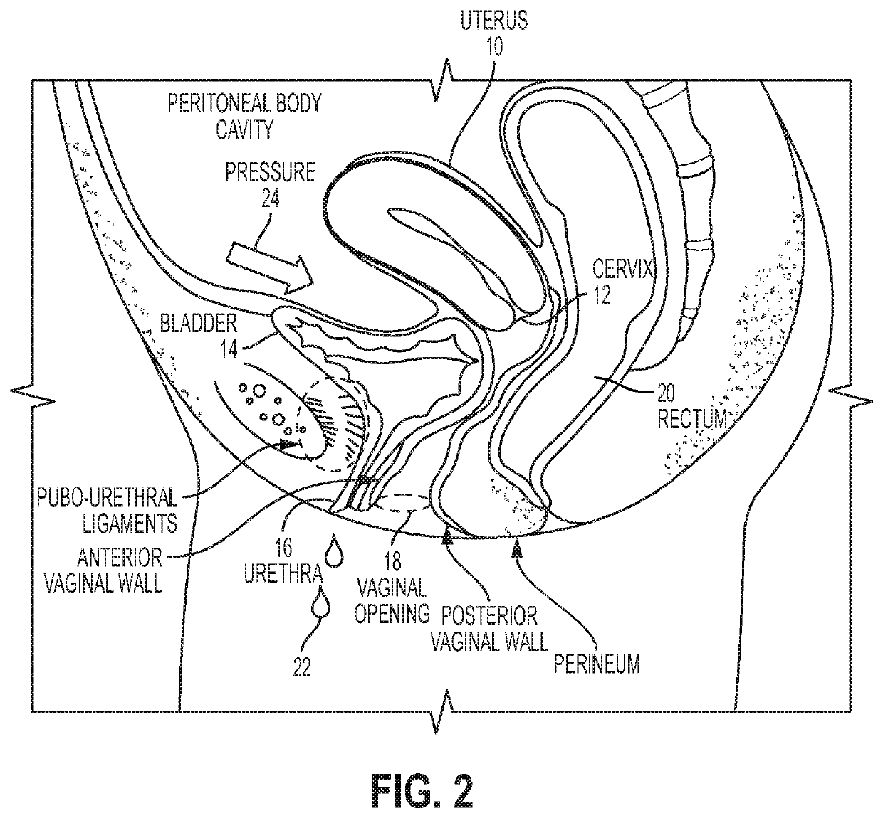 Intravaginal support devices and methods