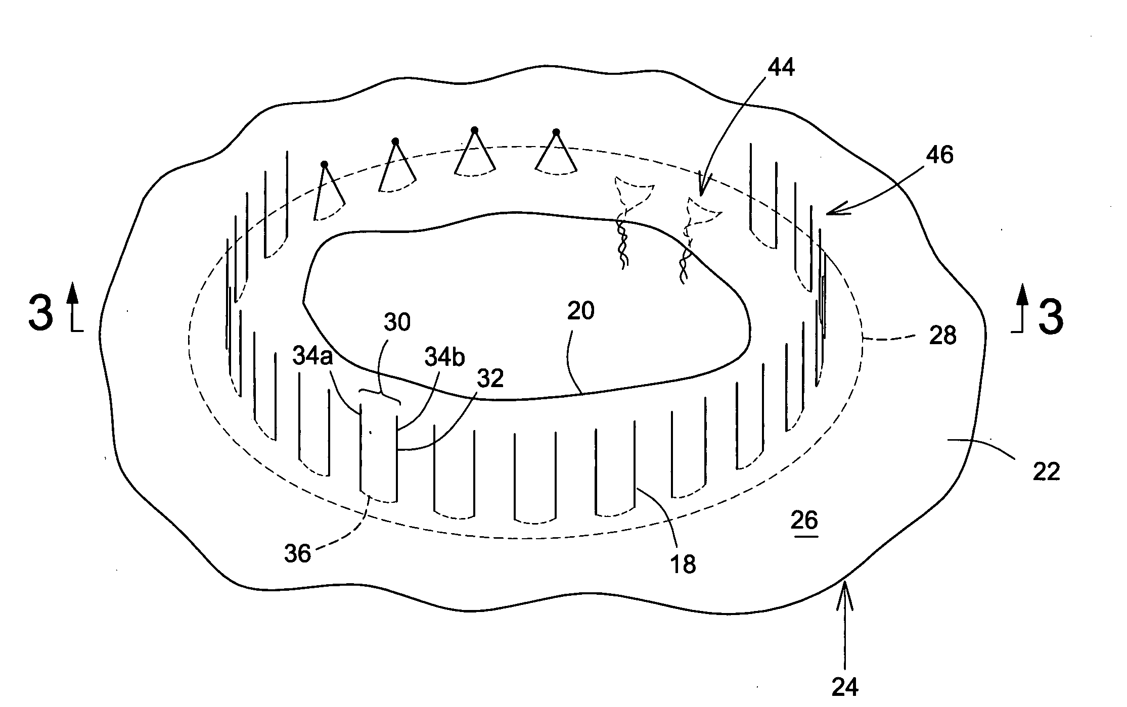 Prosthetic repair patch with integrated sutures