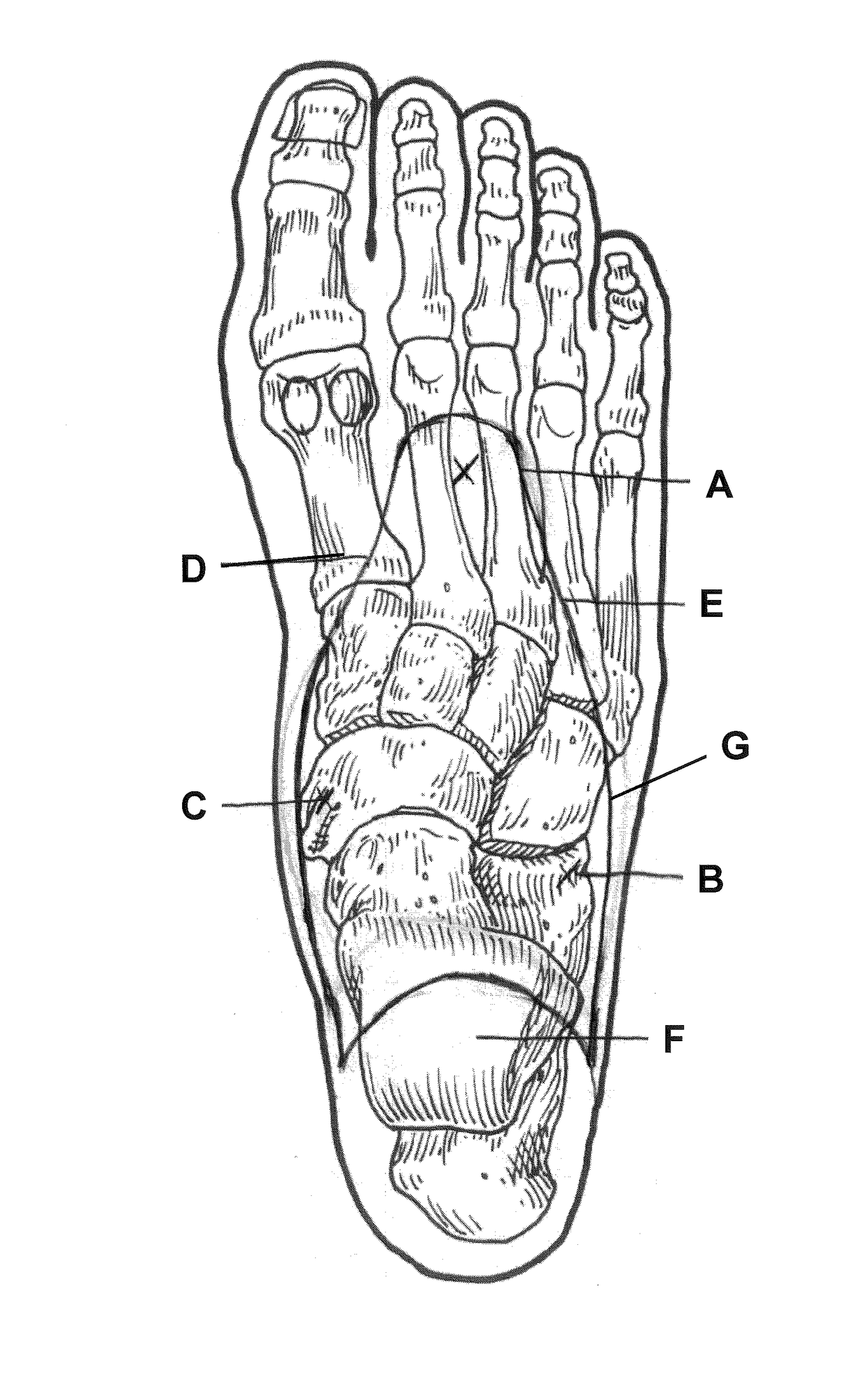 Orthopedic shoe appliance