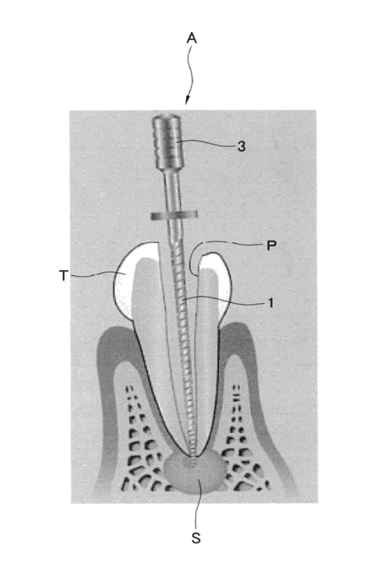 Alveolar bone regenerative apparatus