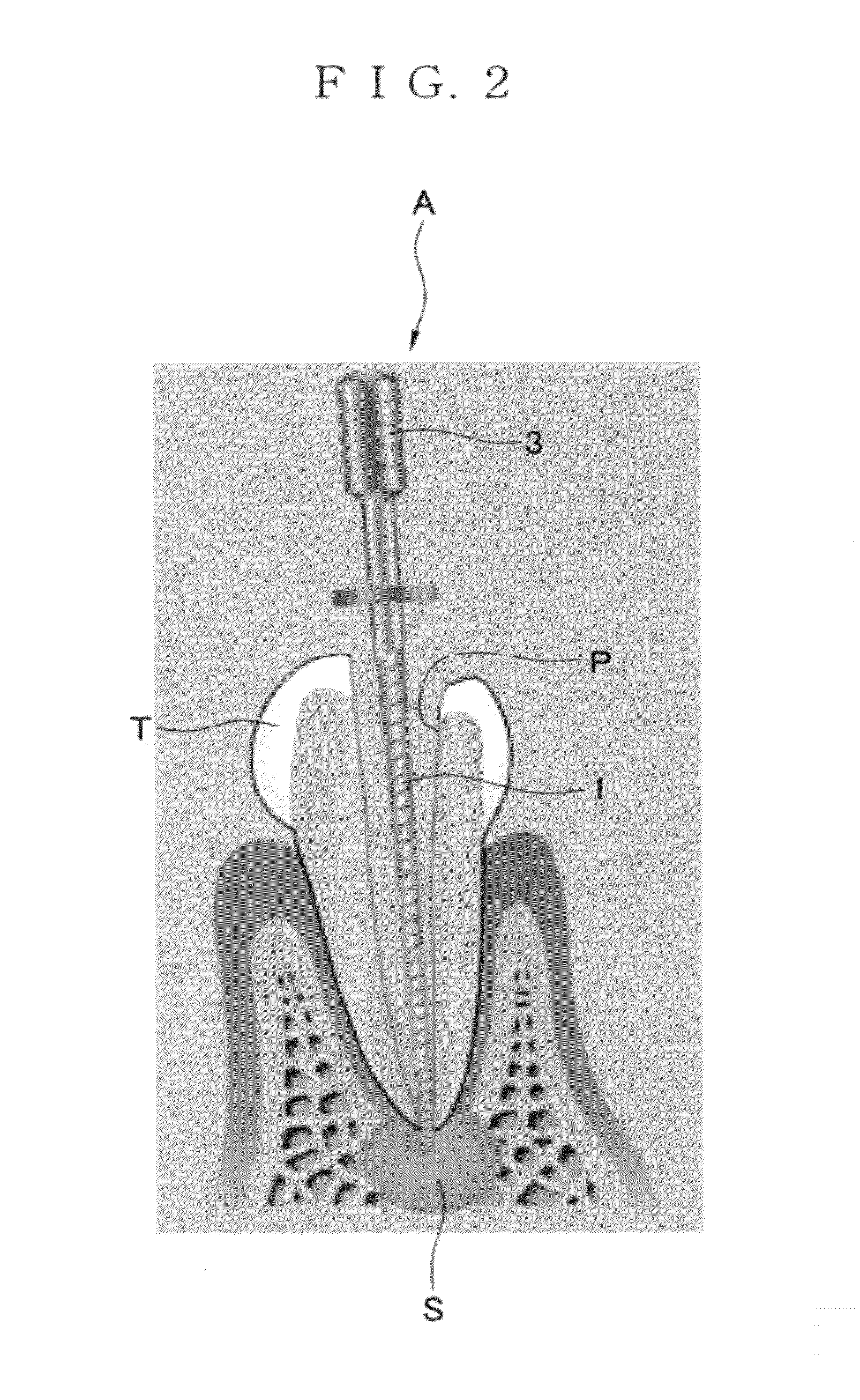 Alveolar bone regenerative apparatus