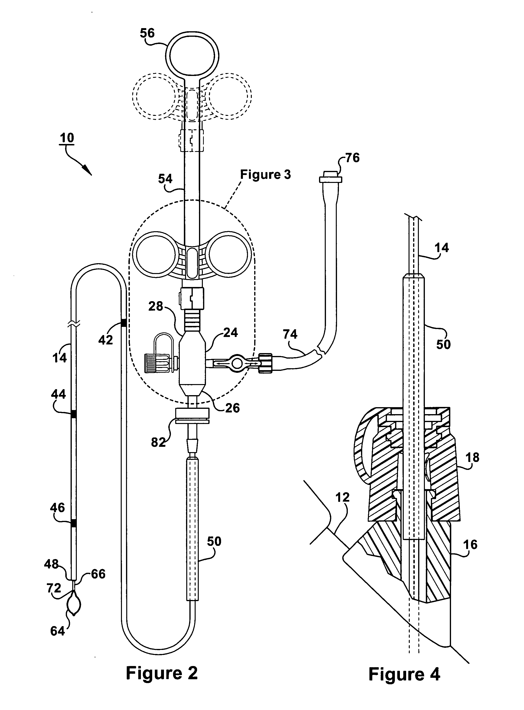 Polypectomy device and method of use