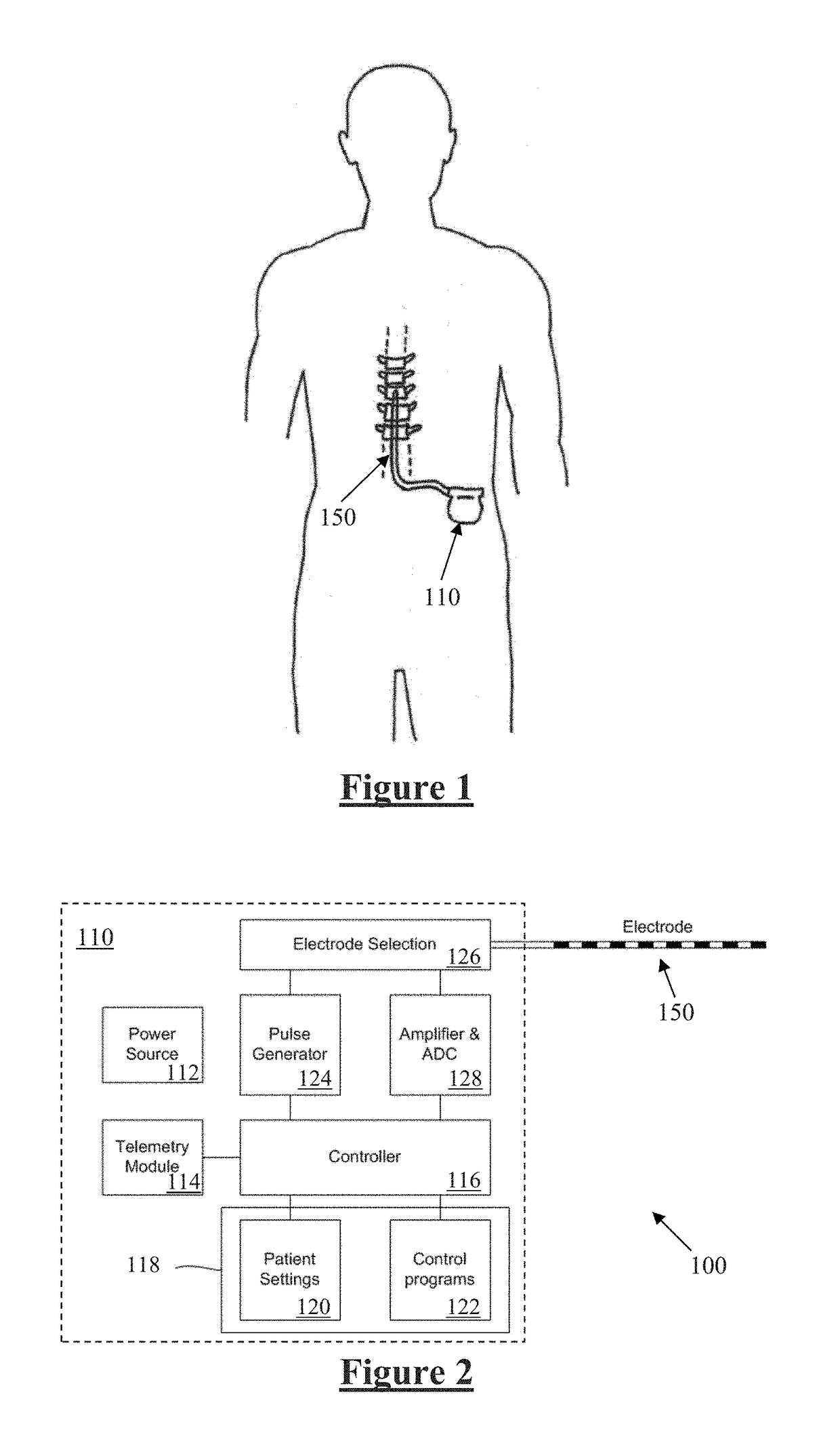 Implantable Electrode Positioning