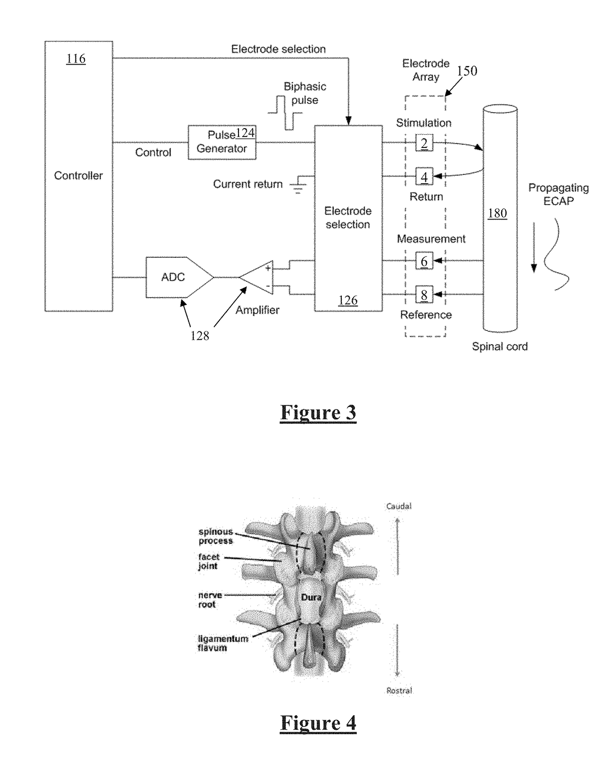 Implantable Electrode Positioning