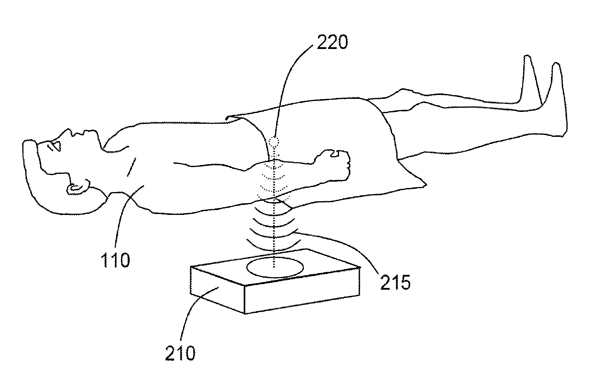 Systems and Methods for Debulking Visceral Fat