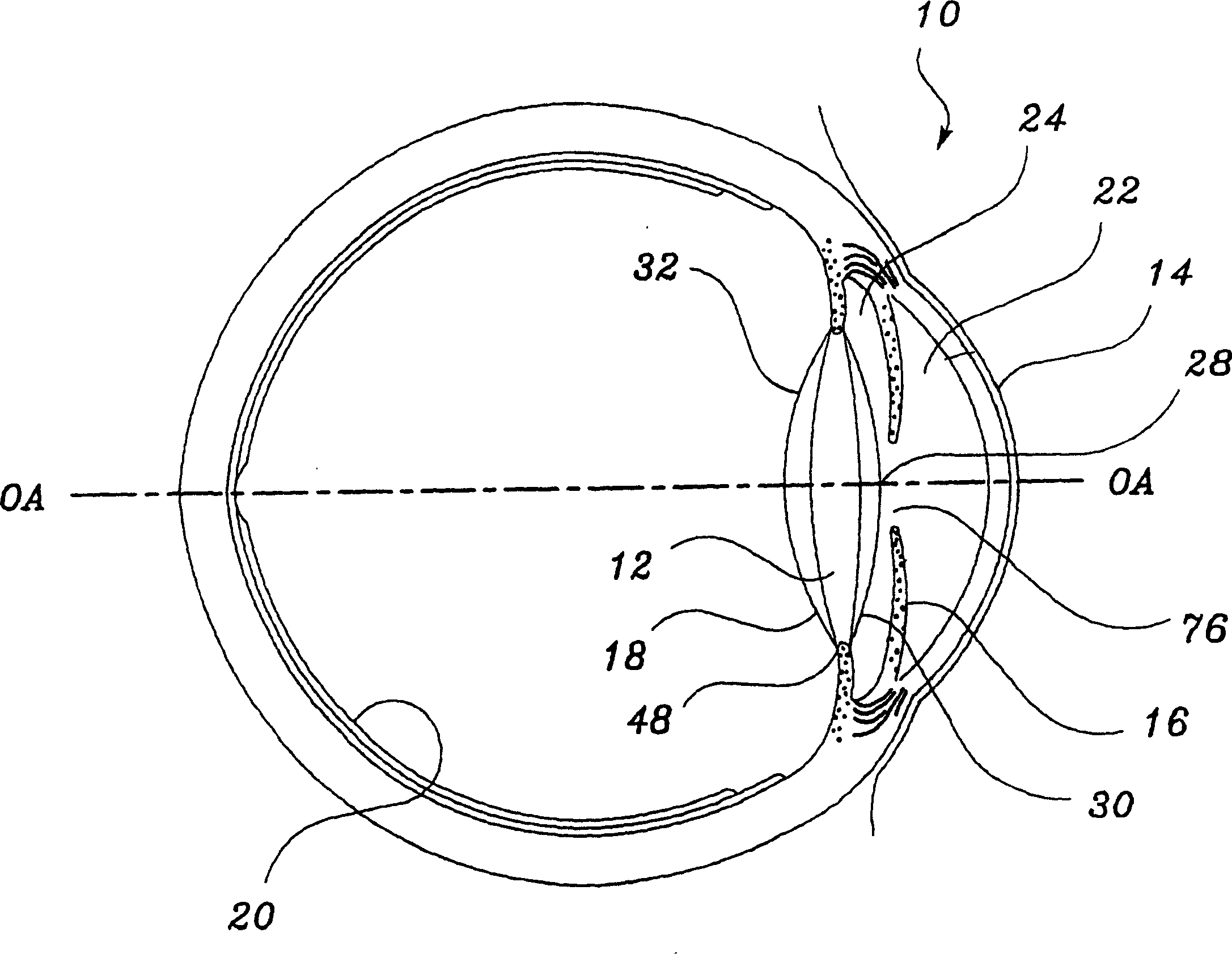 Intraocular lenses provided with angled edges to prevent posterior capsular opacification