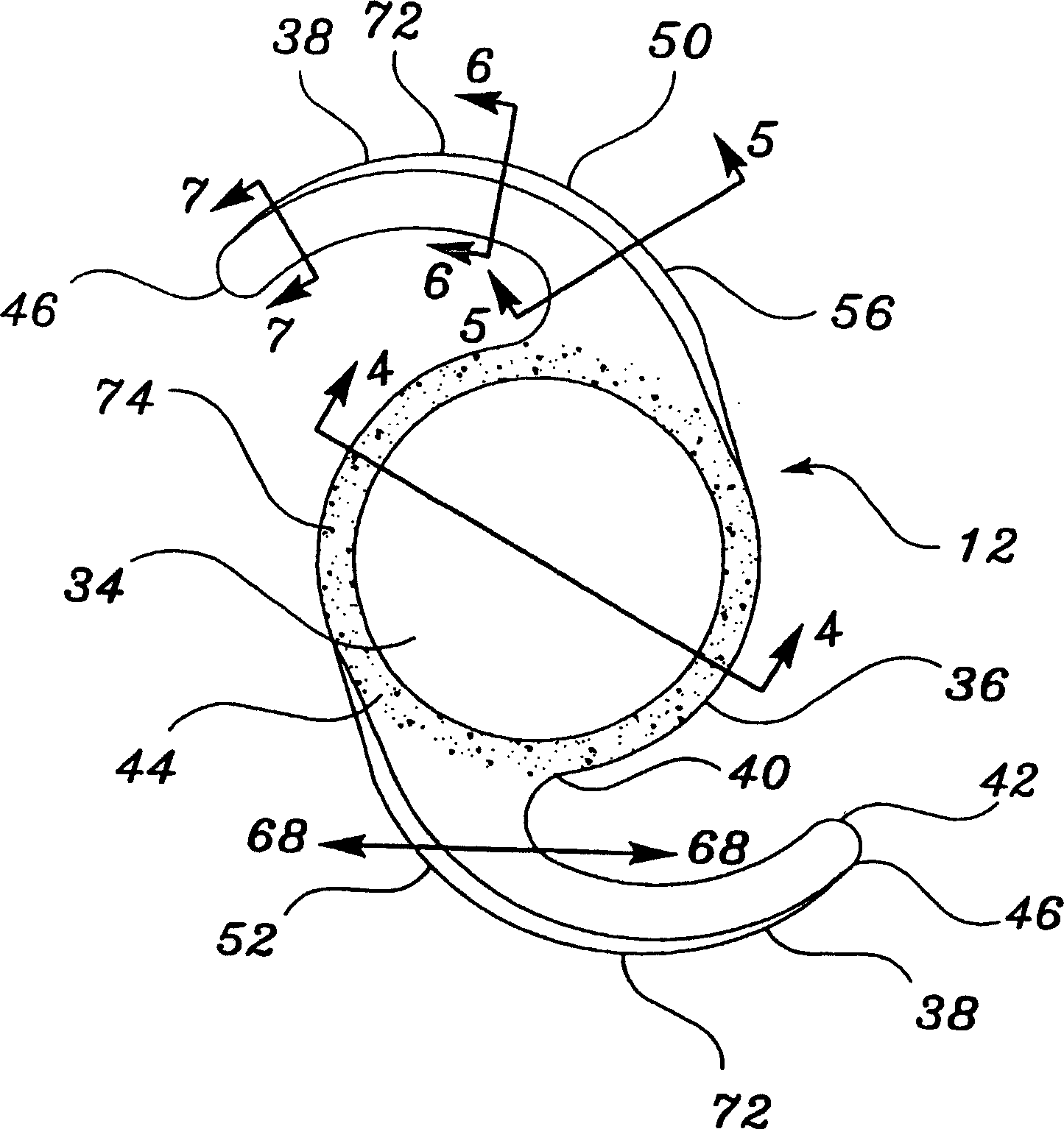 Intraocular lenses provided with angled edges to prevent posterior capsular opacification