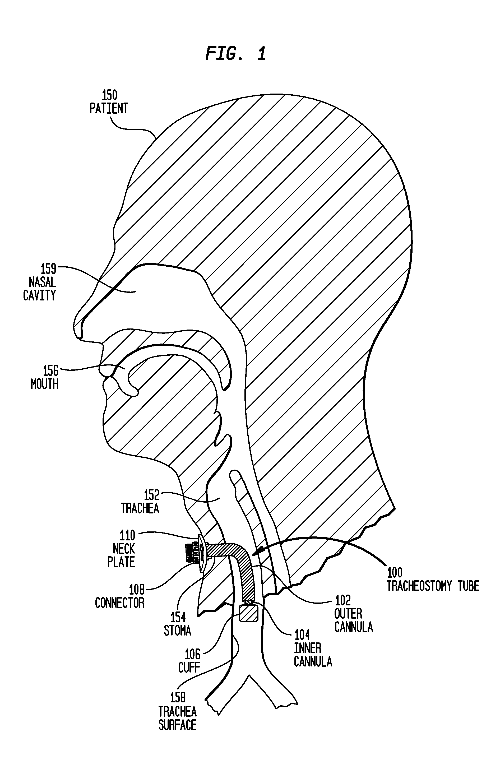 Tracheostomy tube having a cuffed inner cannula