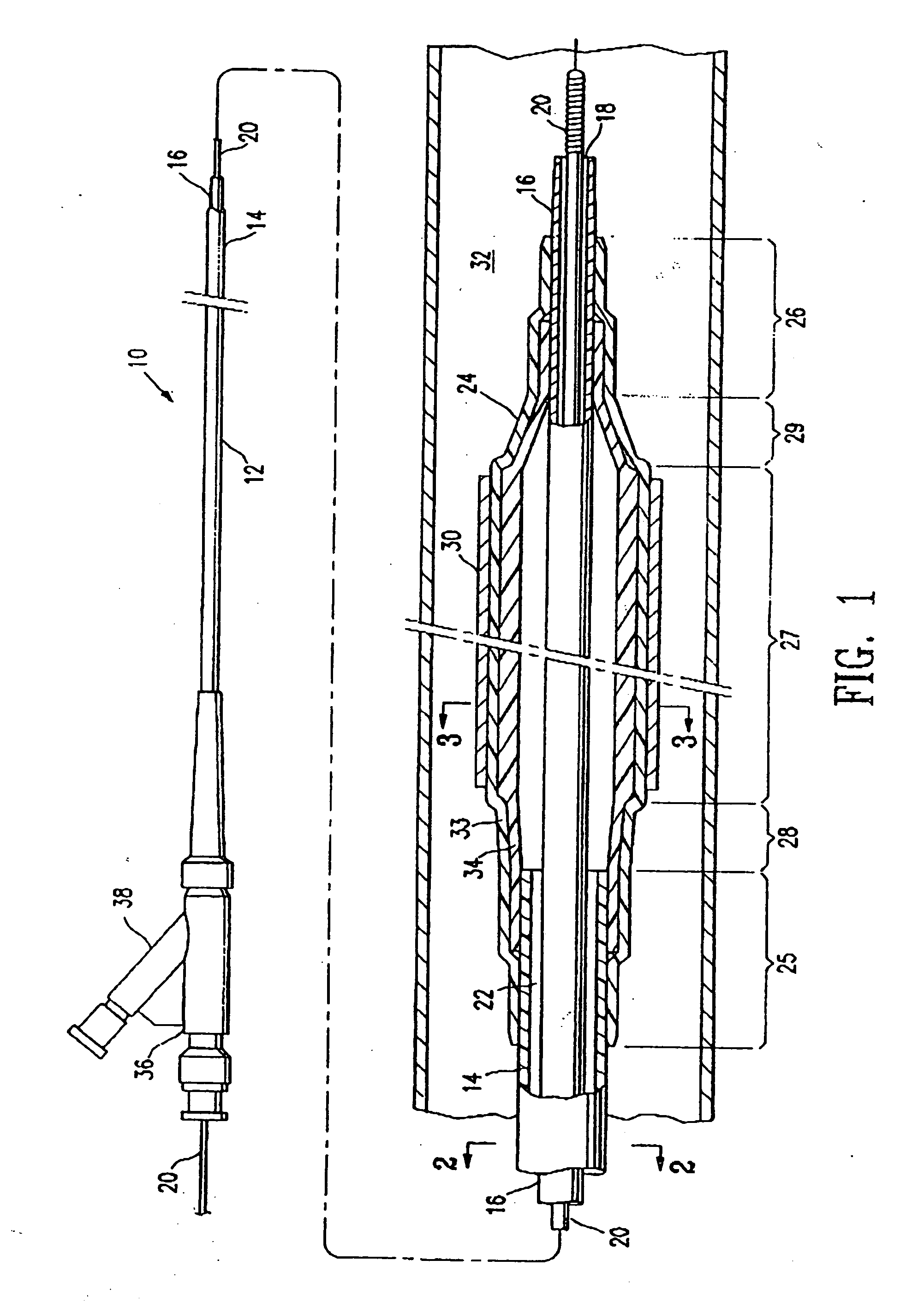 Balloon catheter having a balloon with a thickened wall portion