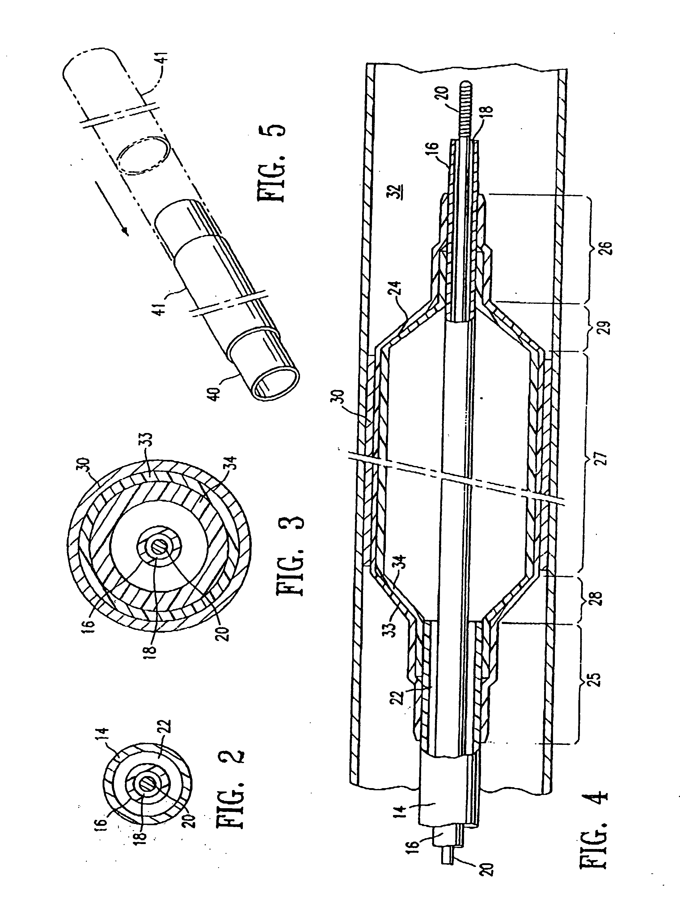 Balloon catheter having a balloon with a thickened wall portion