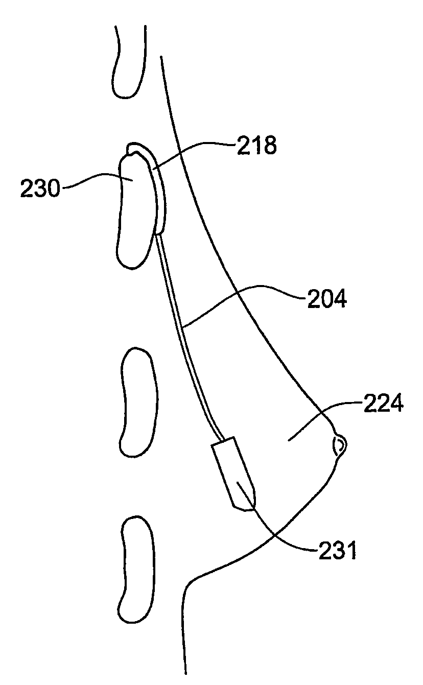 System and method for breast lifting