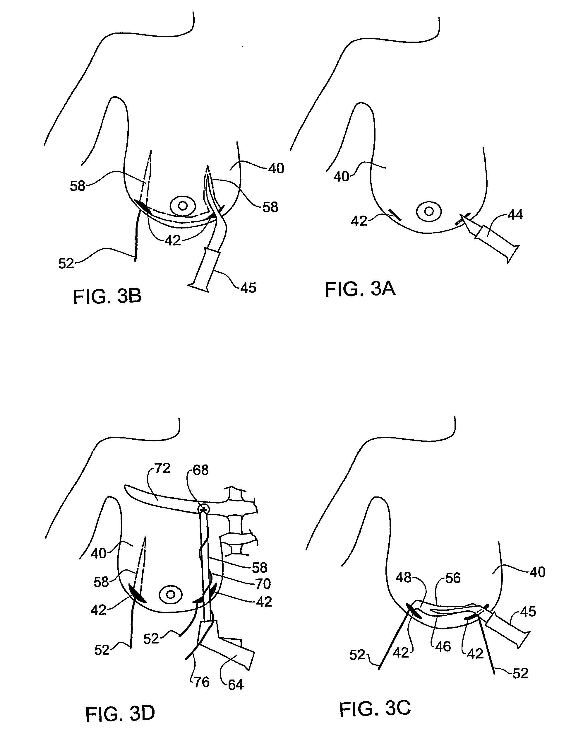 System and method for breast lifting