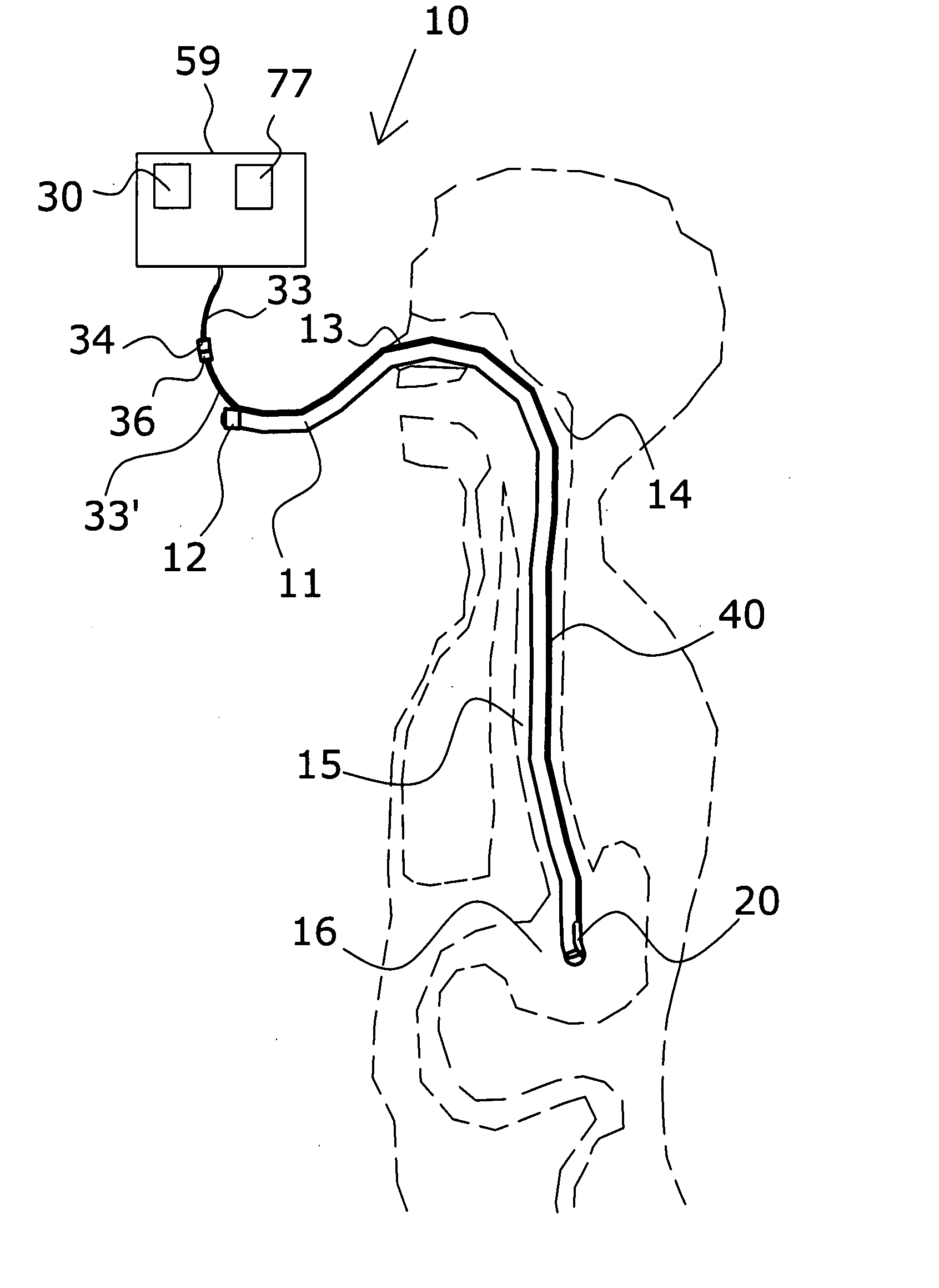 Nasogastric tube placement and monitoring system