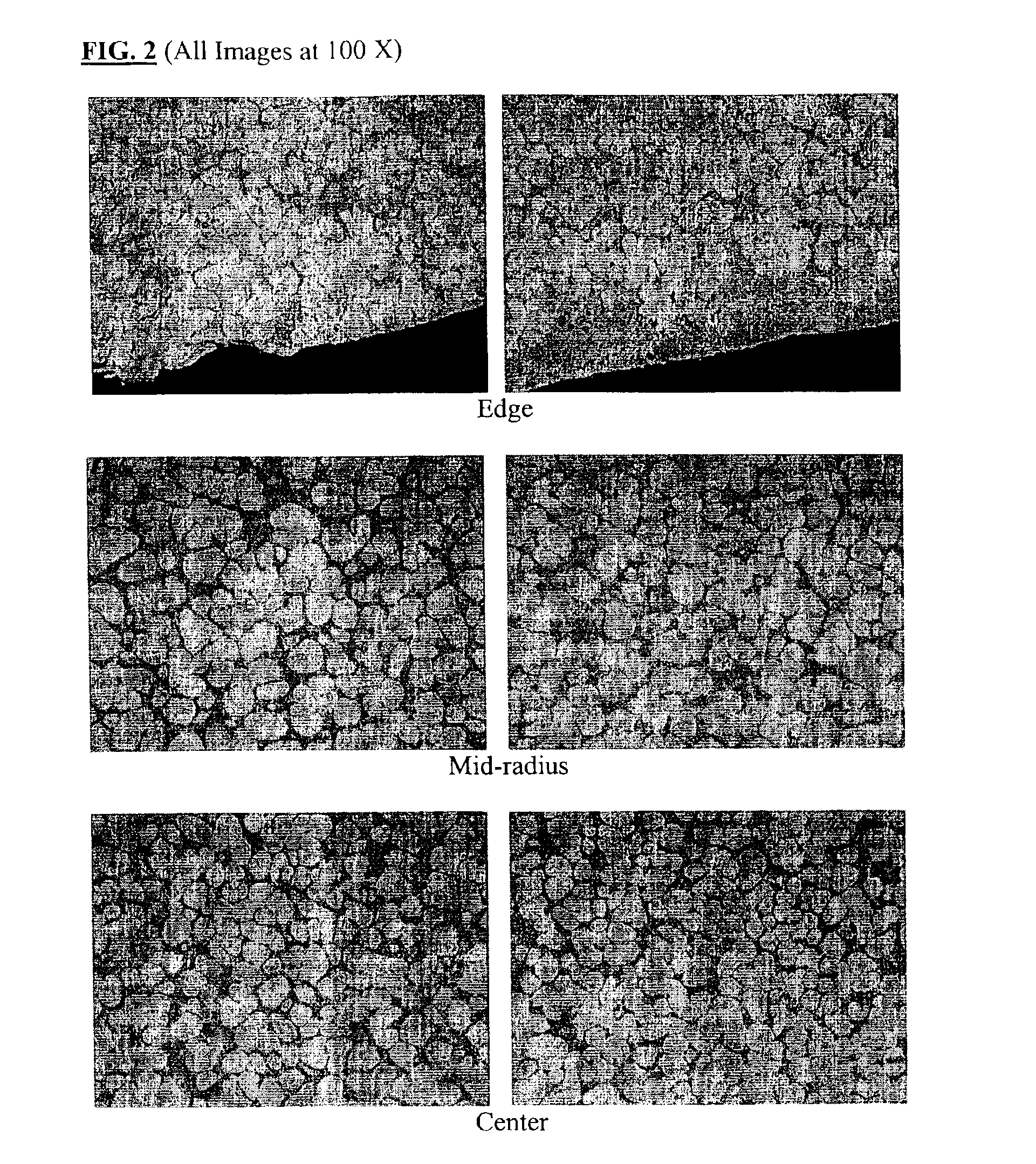 Semi-solid metal casting process of hypoeutectic aluminum alloys