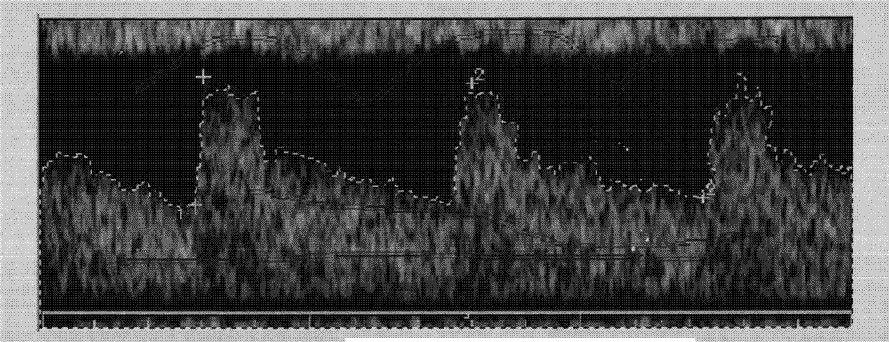 Ultrasonic image renal artery blood flow spectrum signal curve classification method