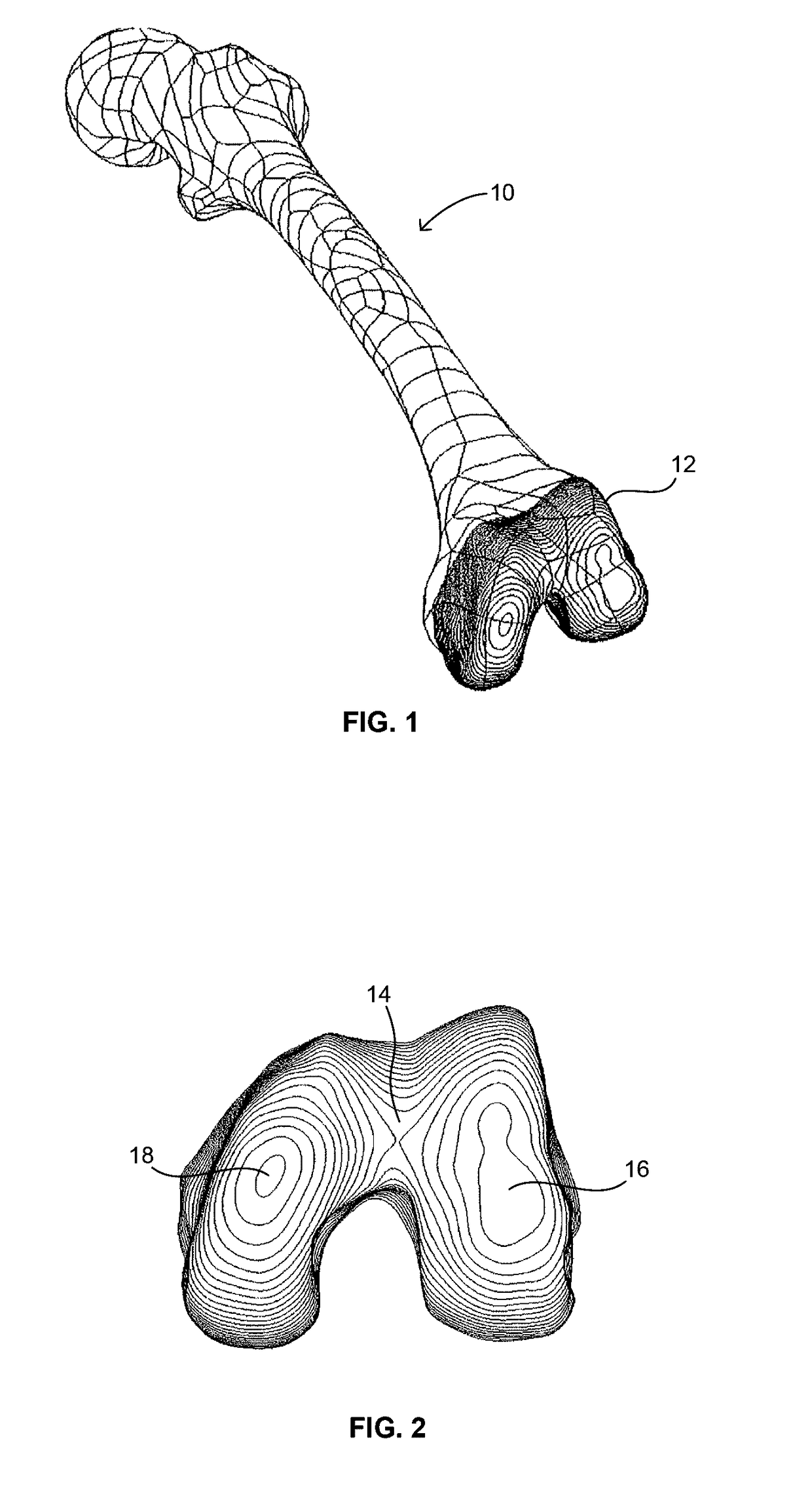 Extended patellofemoral