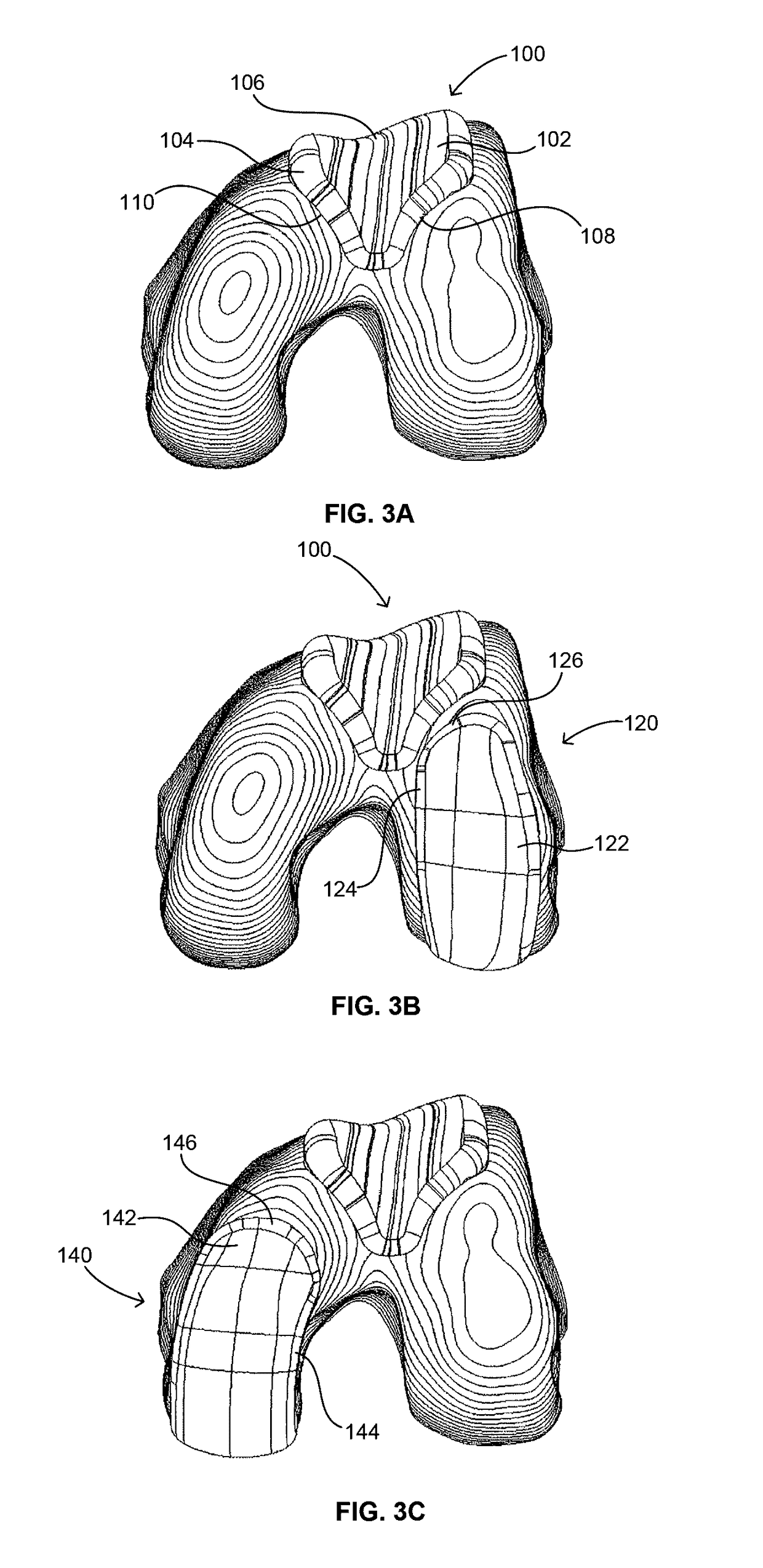 Extended patellofemoral