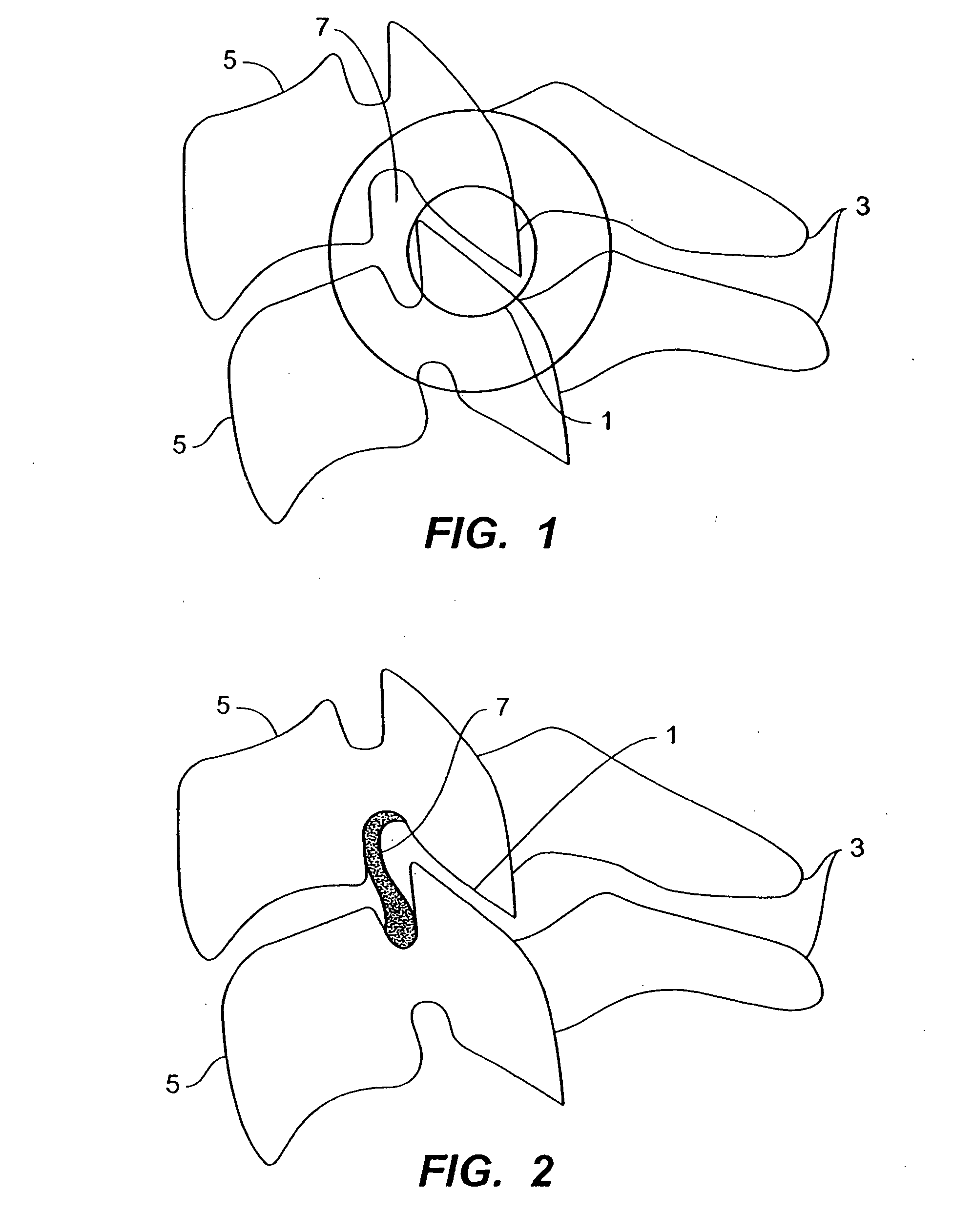 Inter-cervical facet implant with surface enhancements