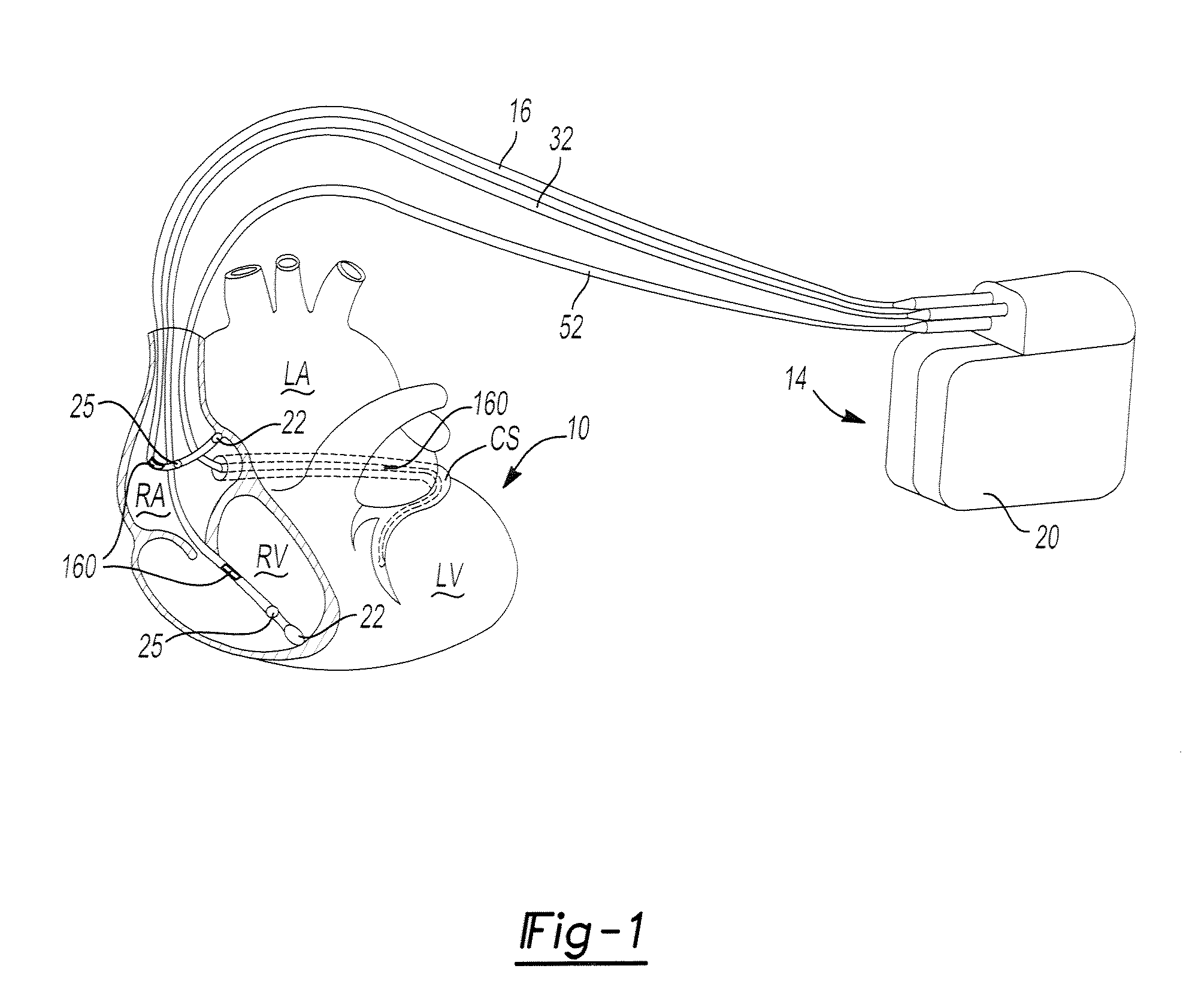 Chronically-implantable active fixation medical electrical leads and related methods for non-fluoroscopic implantation