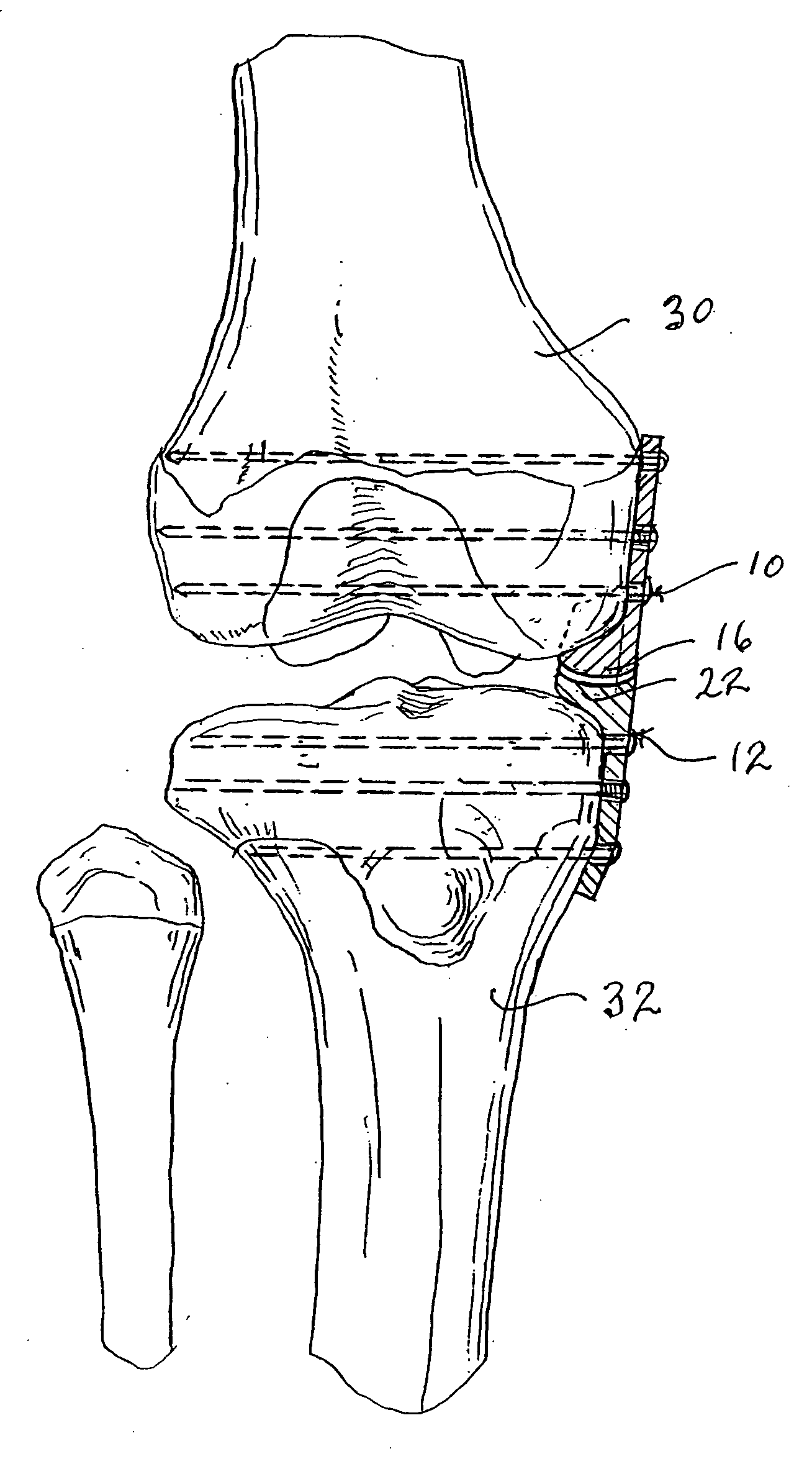 Internal brace for distraction arthroplasty