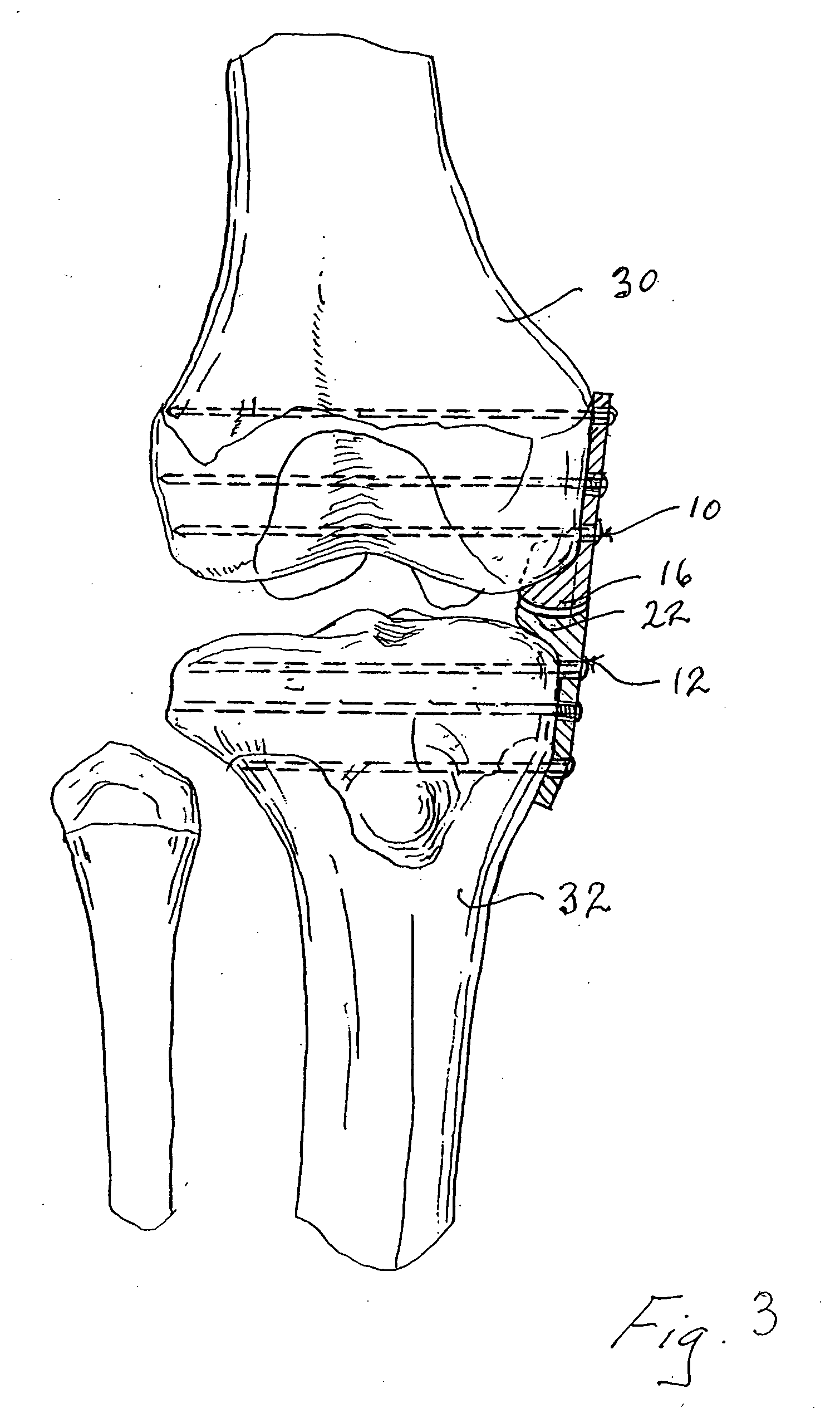 Internal brace for distraction arthroplasty