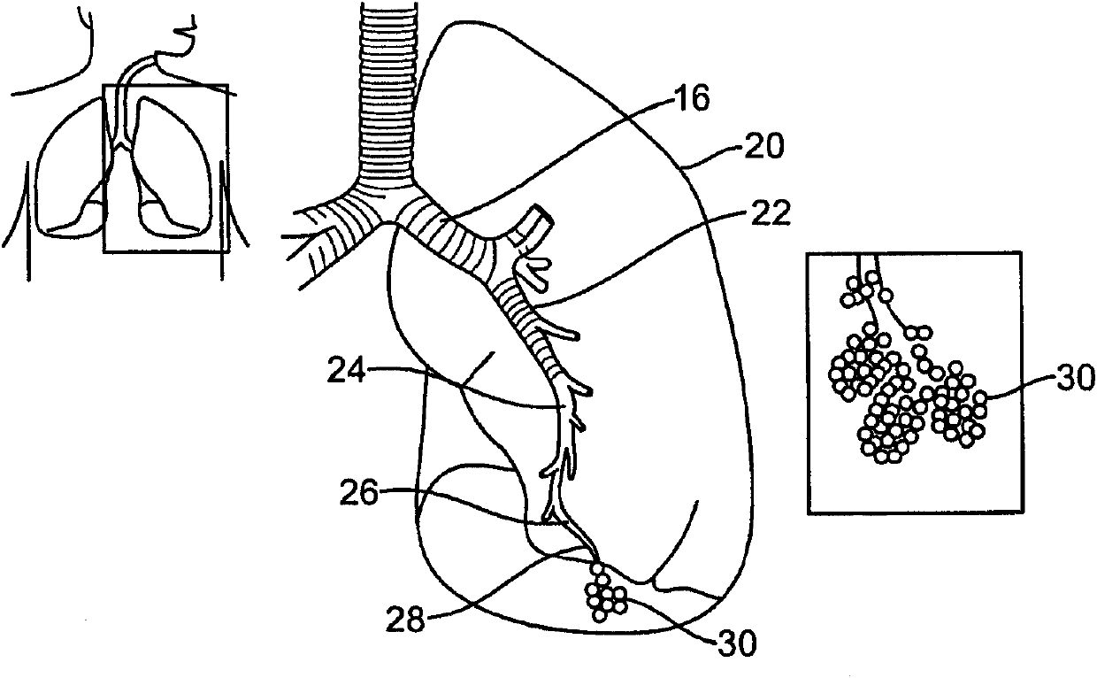 Cross-sectional modification during deployment of an elongate lung volume reduction device