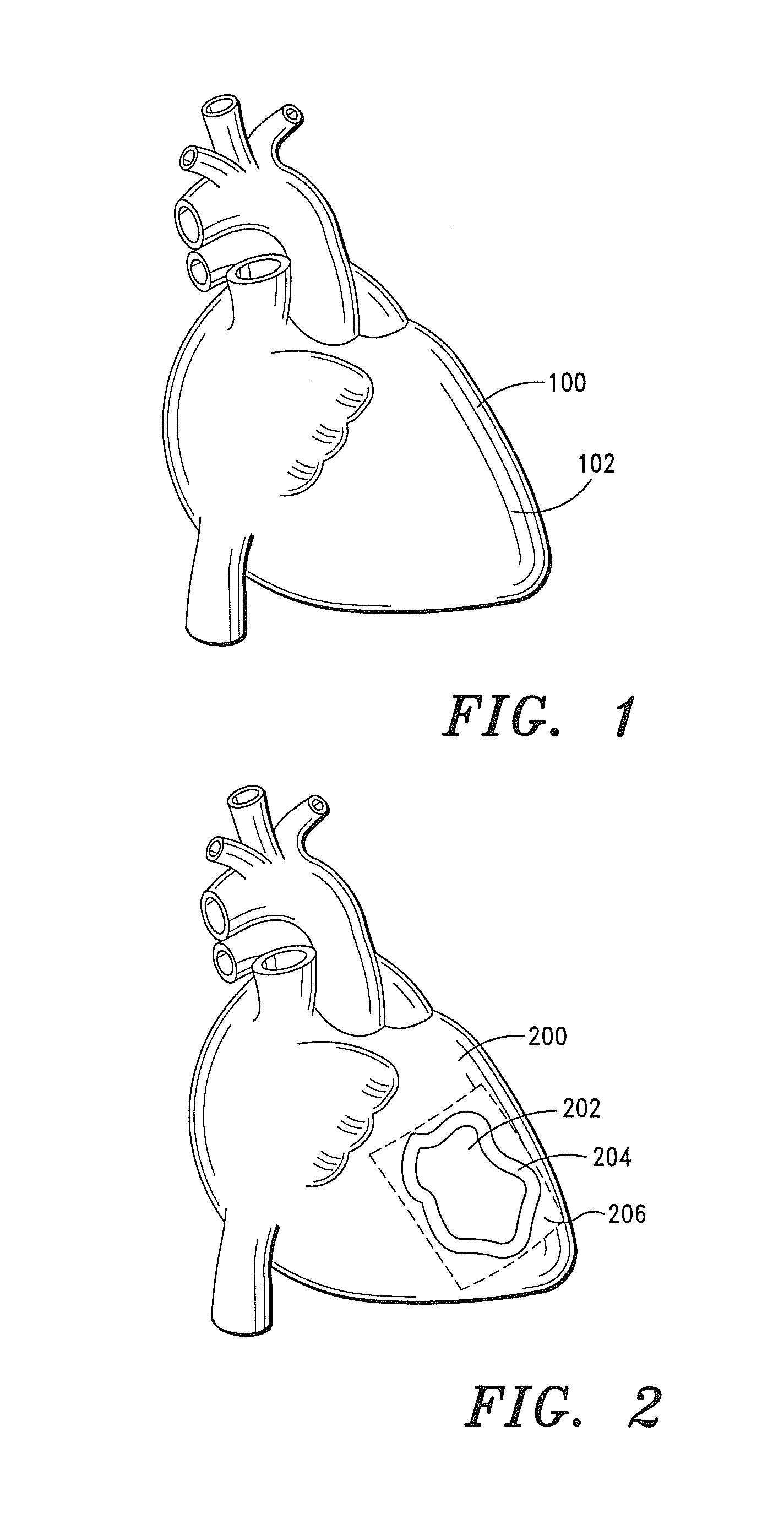 Intra-Myocardial Agent Delivery Device, System and Method