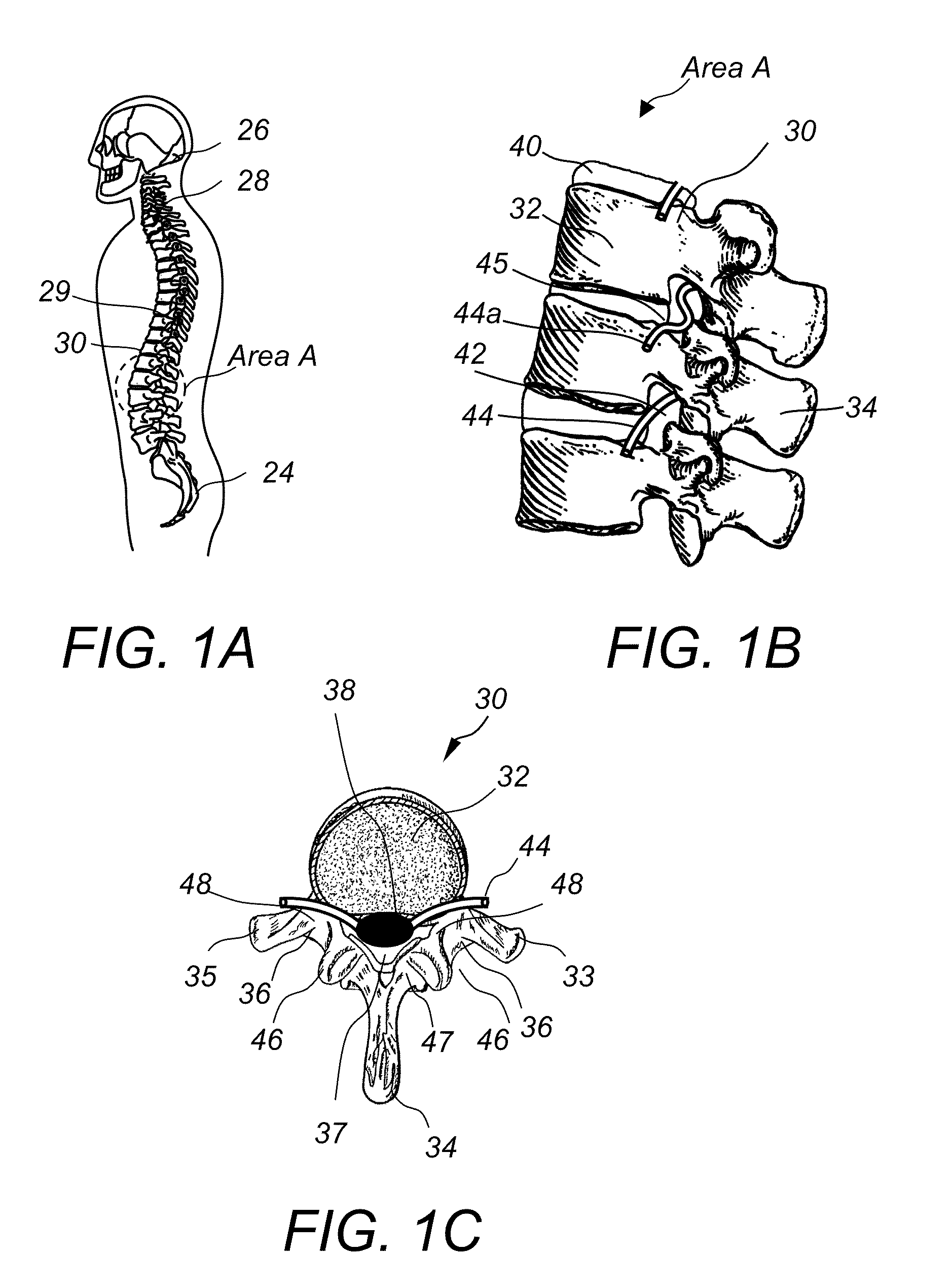 Spinous process fixation implant