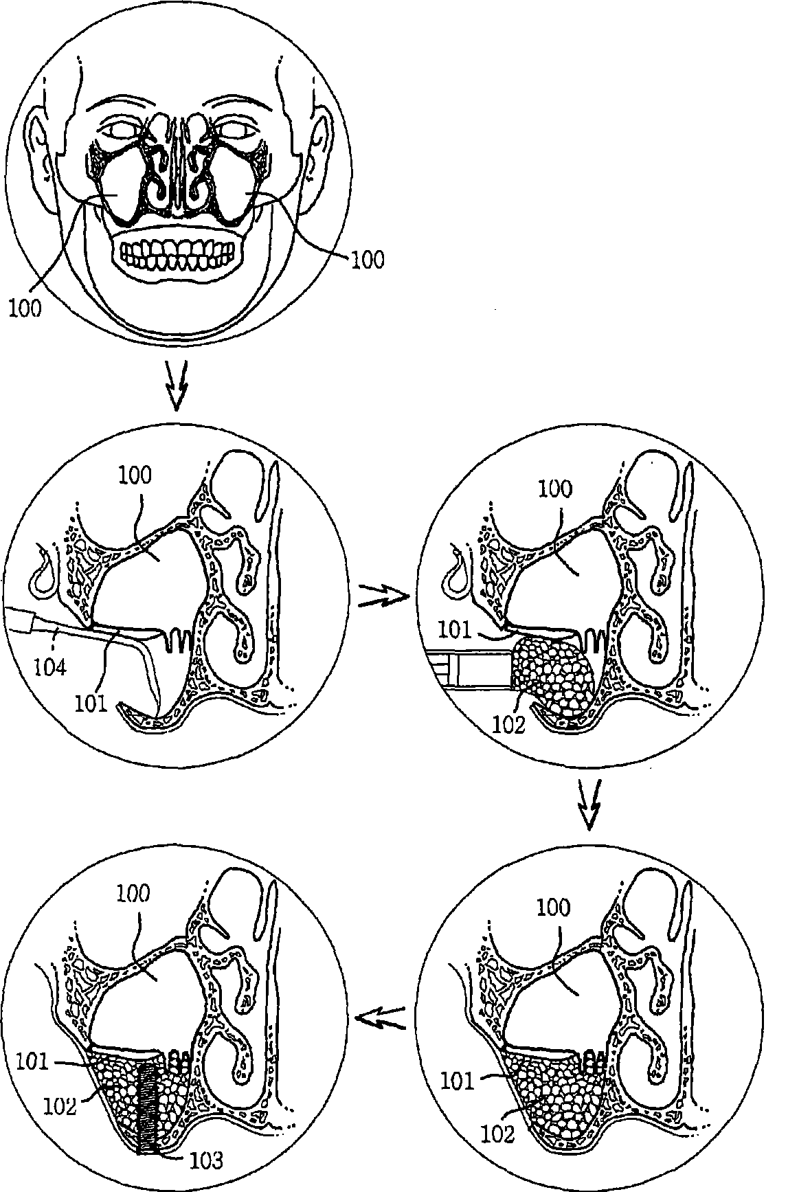 Reamer for operating implant