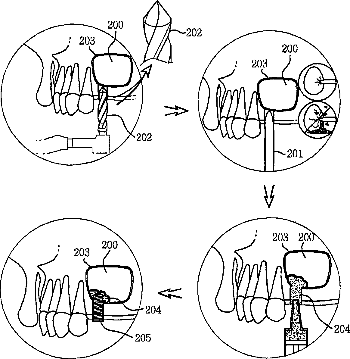 Reamer for operating implant