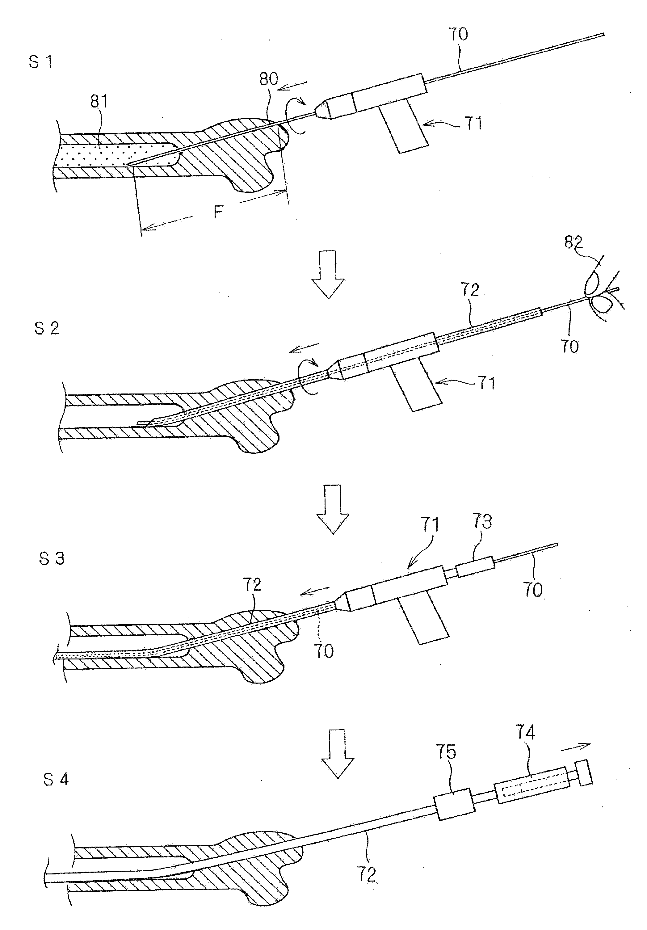 Double needle for medical treatment, bone puncture needle, and bone marrow harvesting device