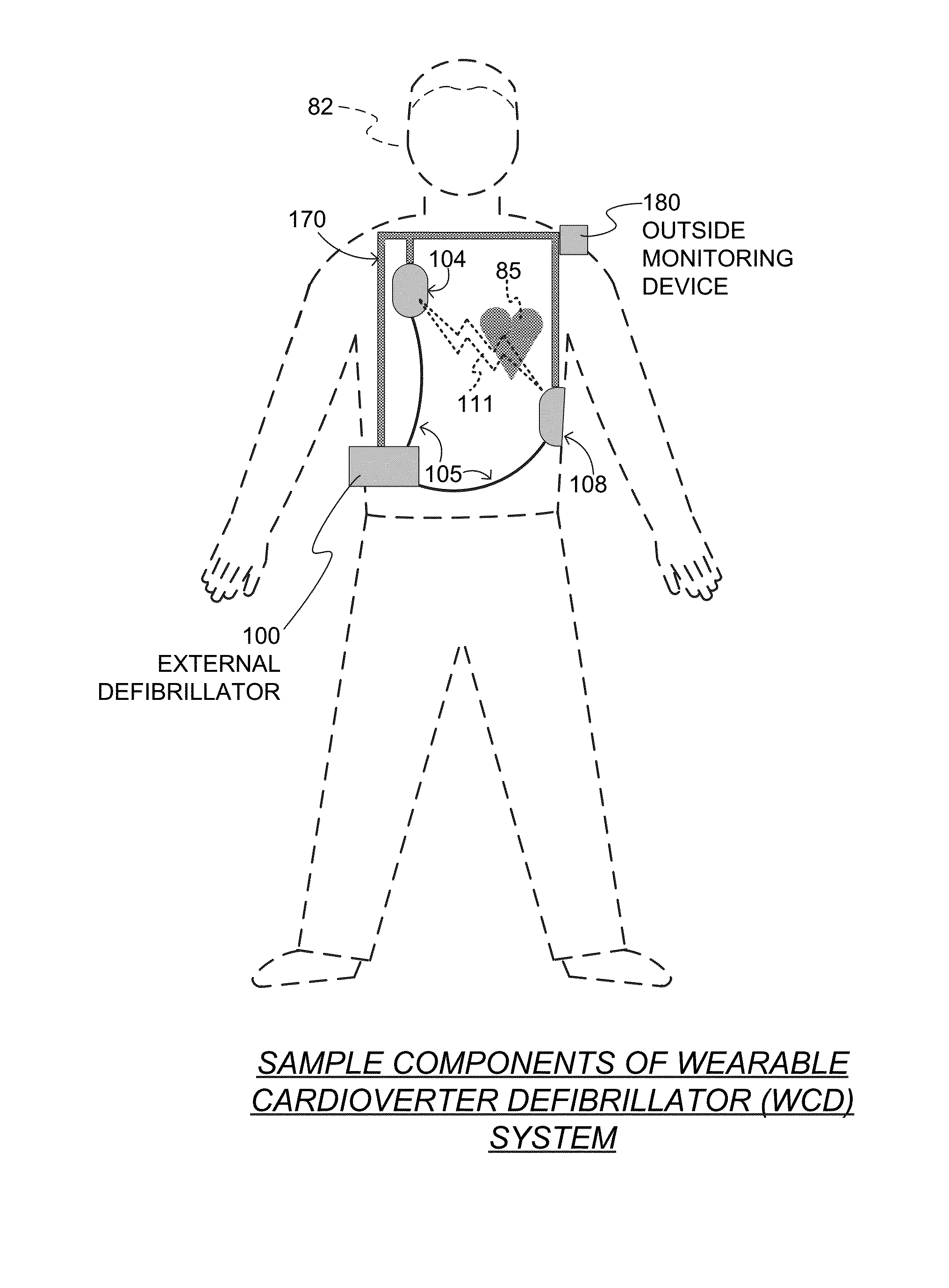 Wearable cardioverter defibrillator (WCD) system making shock/no shock determinations from multiple patient parameters