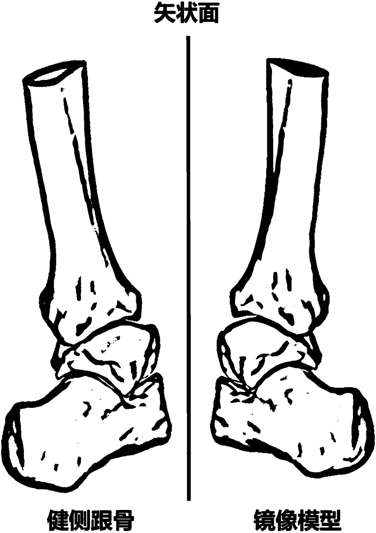 Design method of personalized 3D printing calcaneal plate based on topological optimization