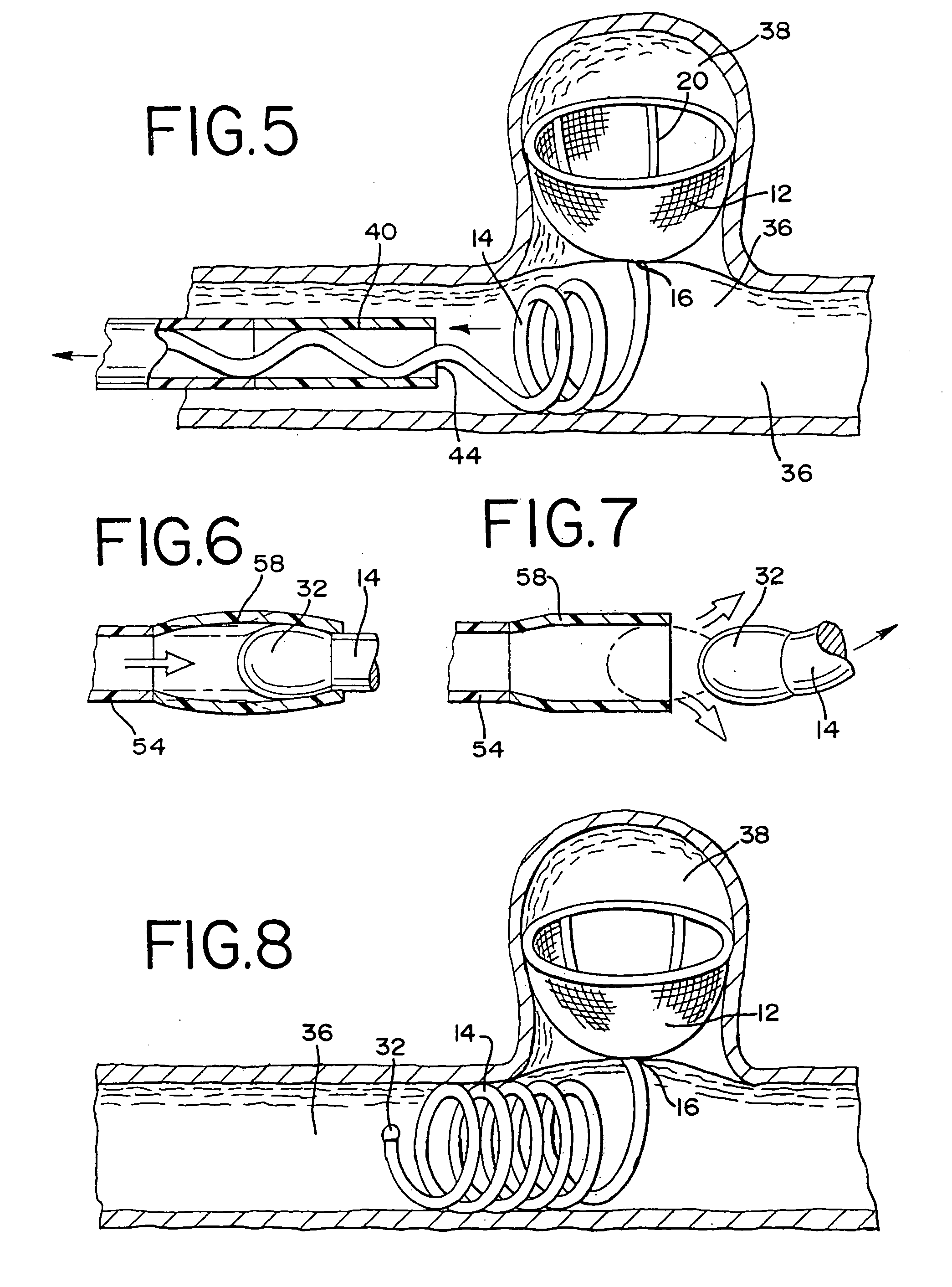 Stent embolization device